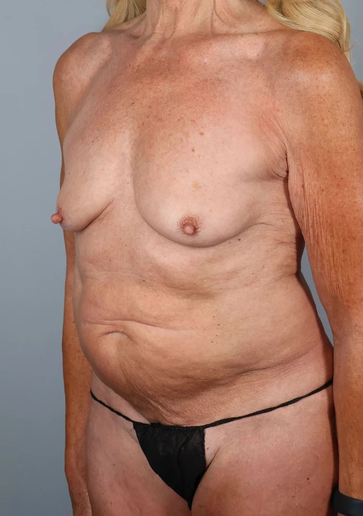 Case 5001 — Oblique before