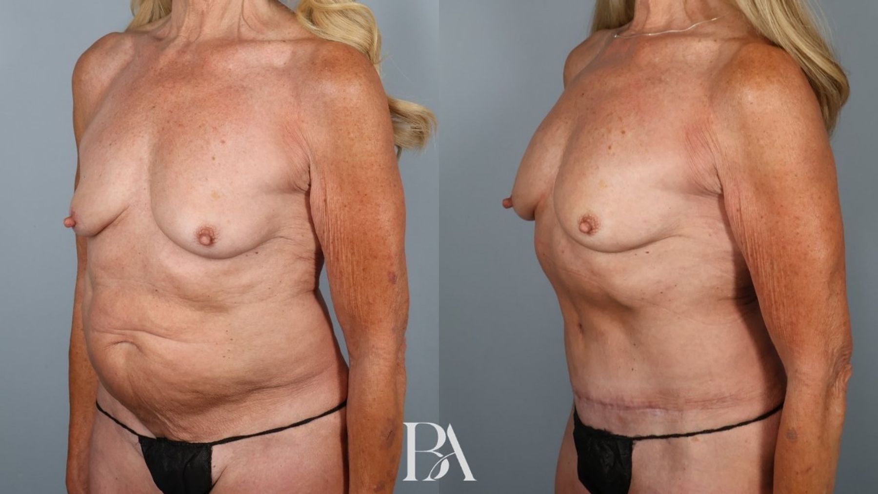 Tummy tuck before and after — three-quarter view, Dr. Beina Azadgoli, Beverly Hills