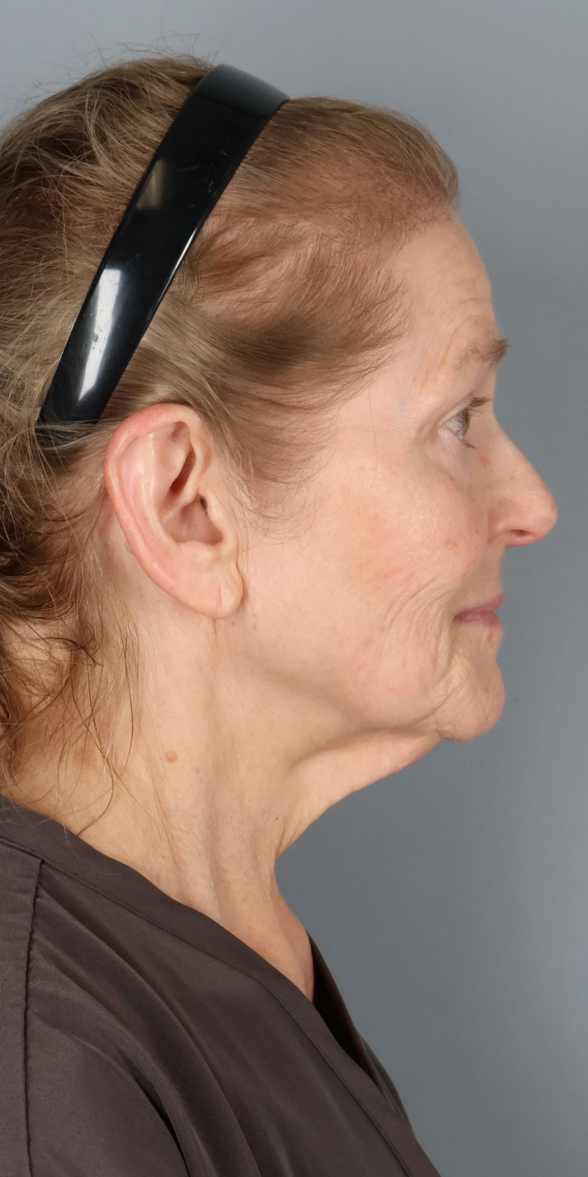 Face/neck lift before — side view, Dr. Beina Azadgoli, Beverly Hills
