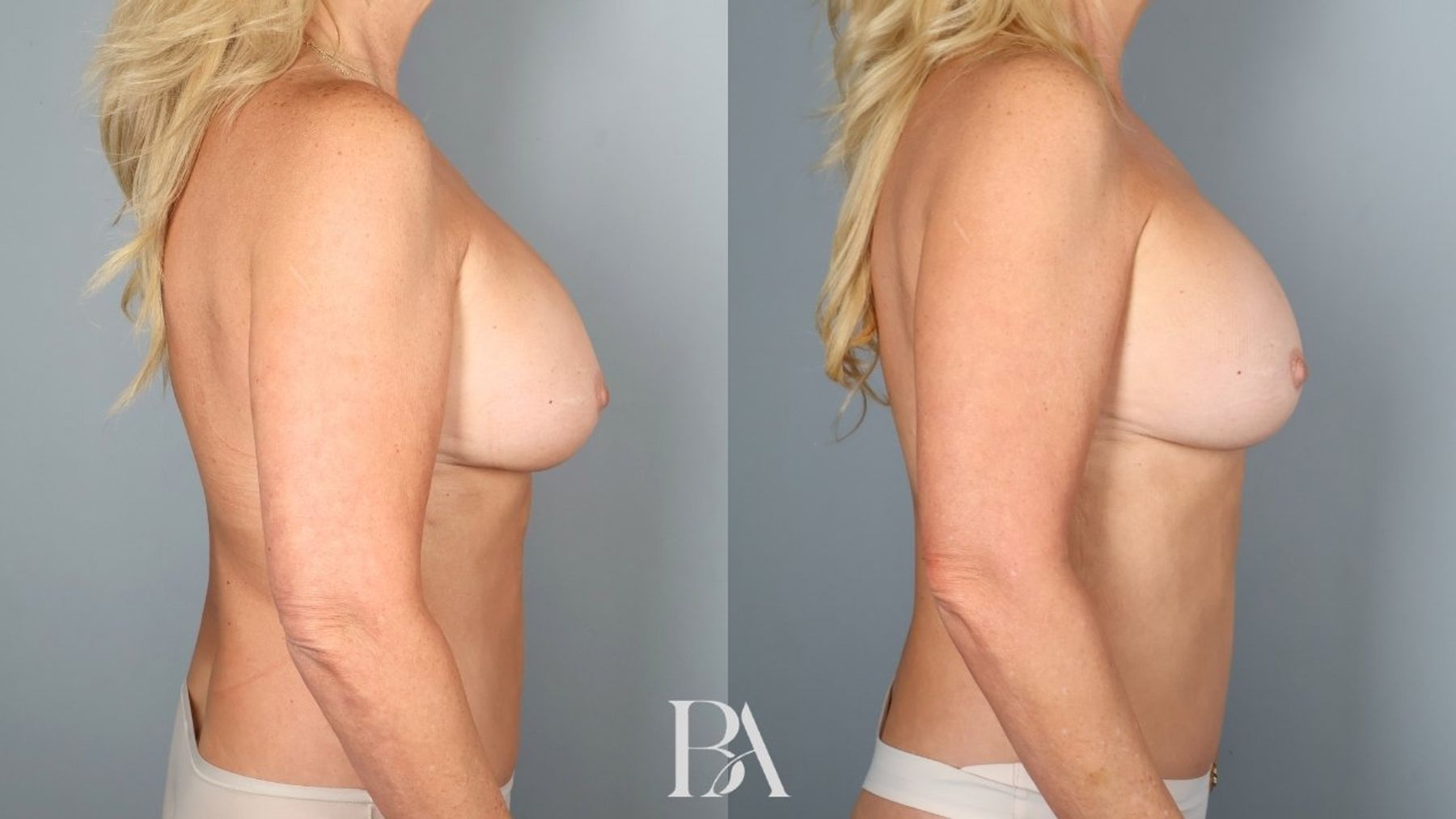 Implant Removal and Replacement before and after — side view, Dr. Beina Azadgoli, Beverly Hills