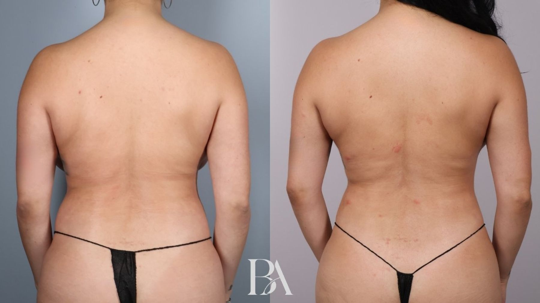 Breast reduction before and after — back view, Dr. Beina Azadgoli, Beverly Hills