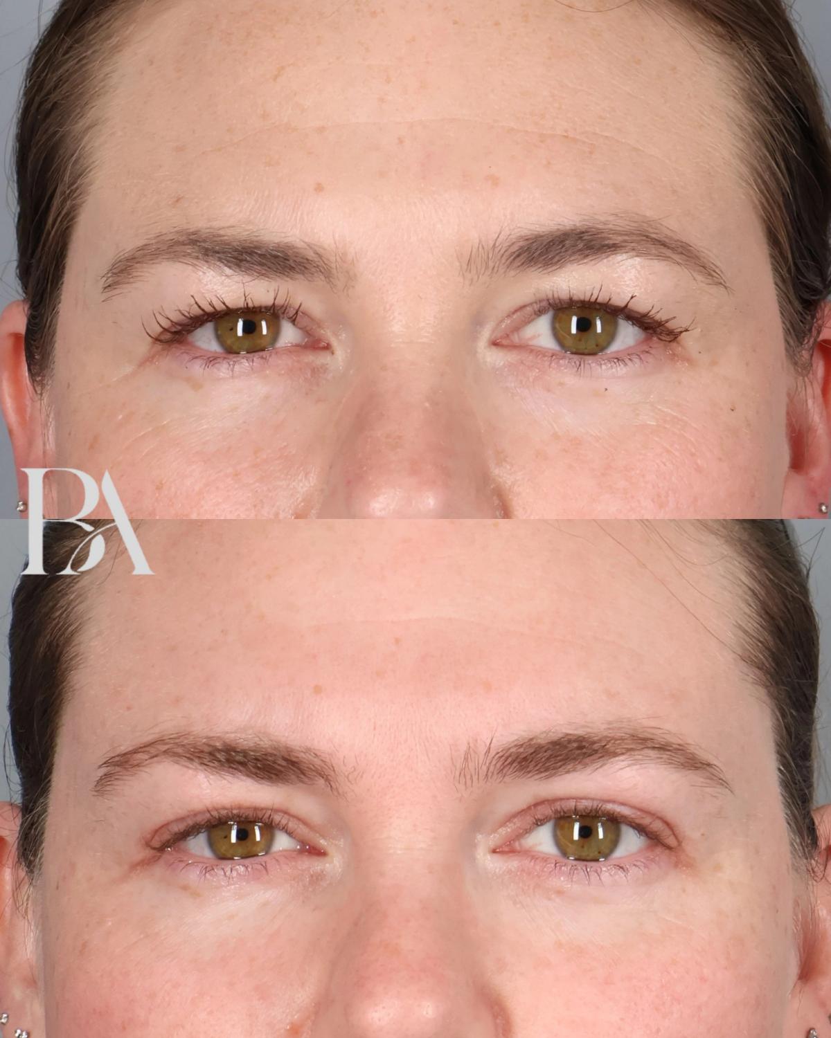 Before and after — Upper Blepharoplasty