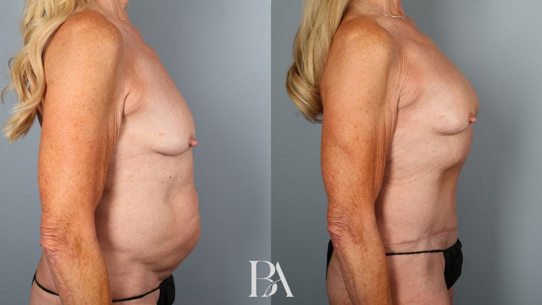Tummy tuck before and after — side view, Dr. Beina Azadgoli, Beverly Hills