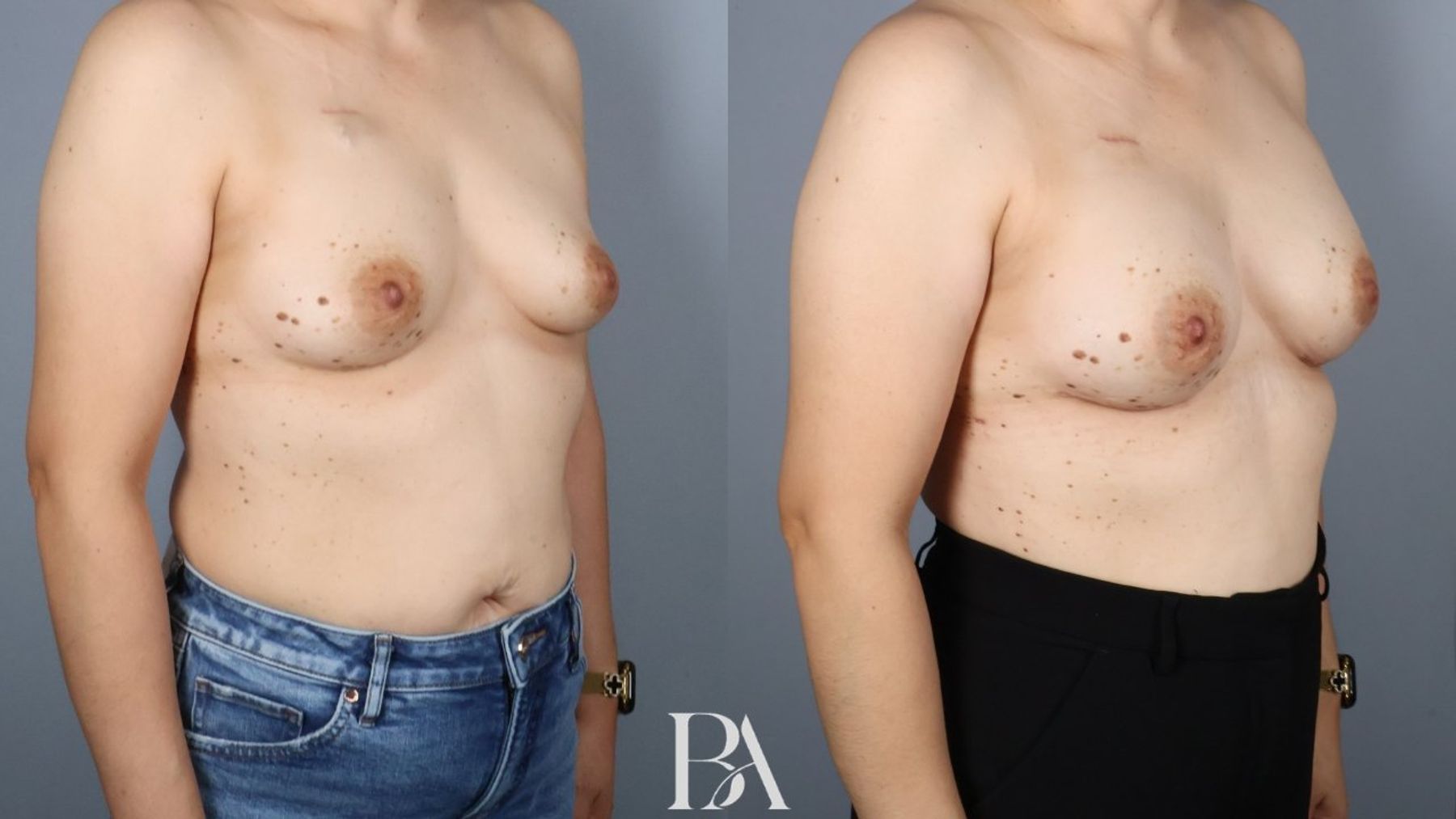 Direct-to-Implant Reconstruction before and after — side view, Dr. Beina Azadgoli, Beverly Hills