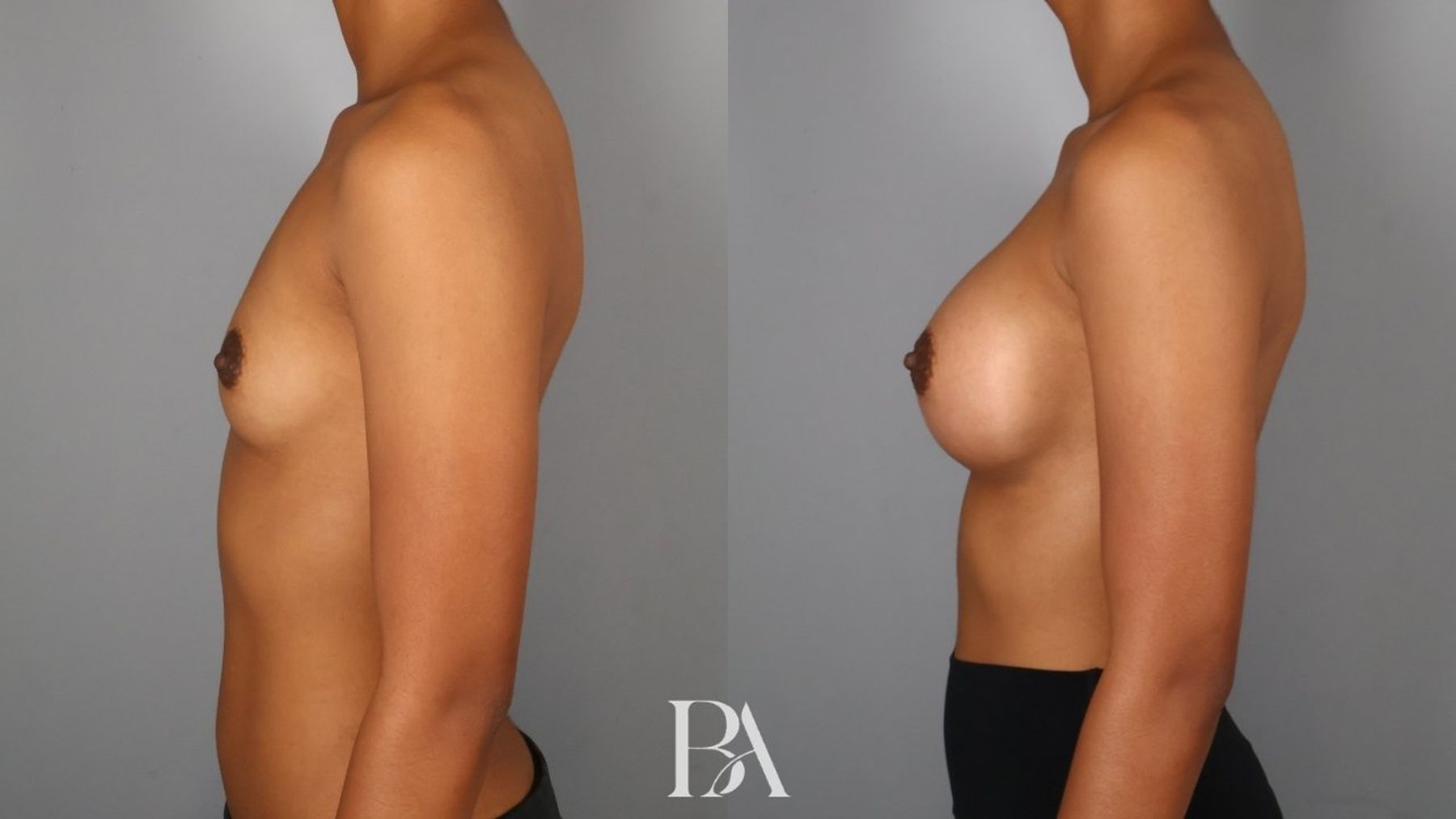 Breast augmentation before and after — side view, Dr. Beina Azadgoli, Beverly Hills