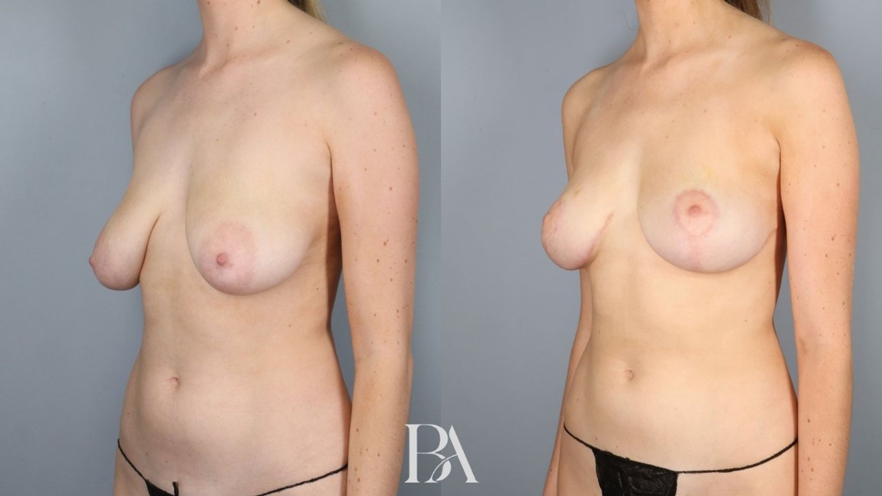 Breast lift before and after — three-quarter view, Dr. Beina Azadgoli, Beverly Hills