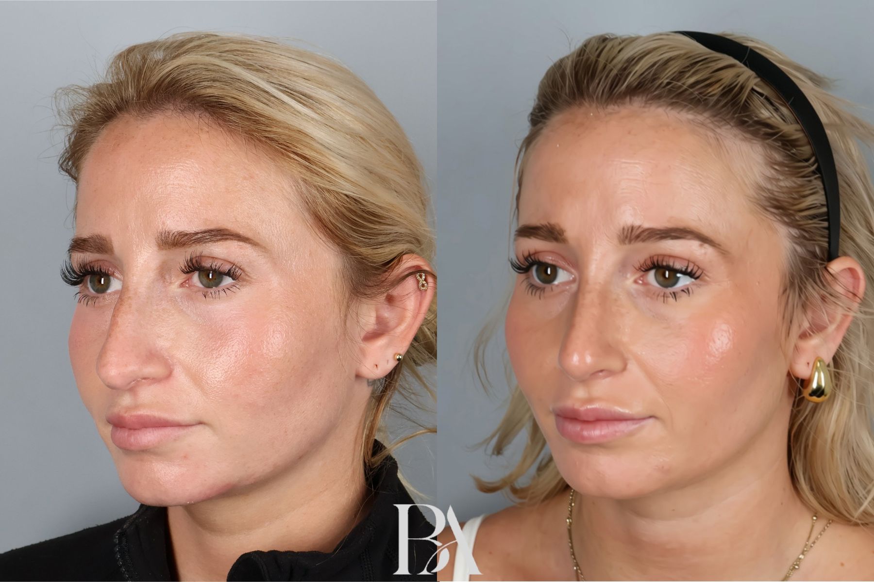 Rhinoplasty before and after — side view, Dr. Beina Azadgoli, Beverly Hills