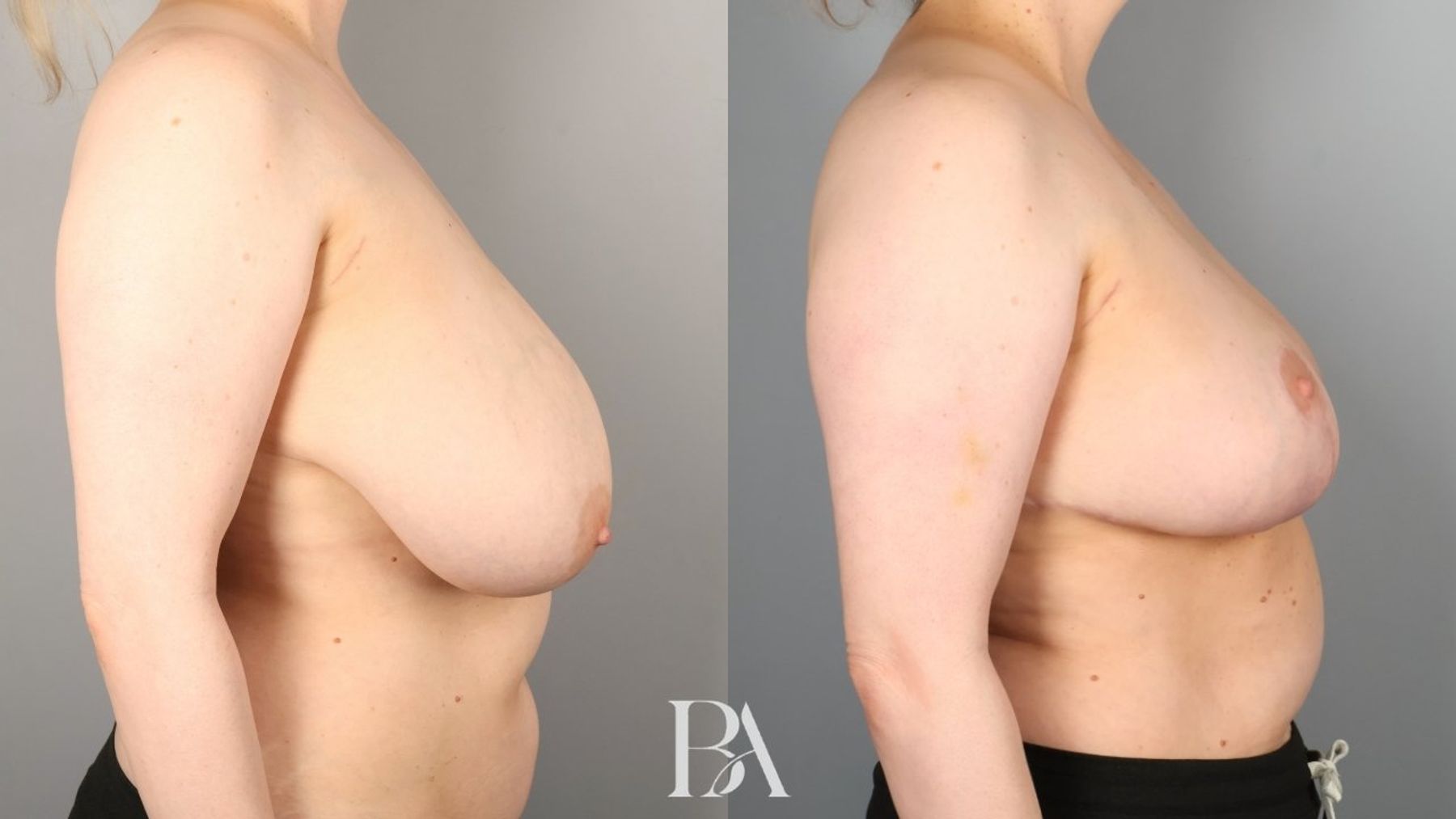Oncoplastic Reduction before and after — side view, Dr. Beina Azadgoli, Beverly Hills