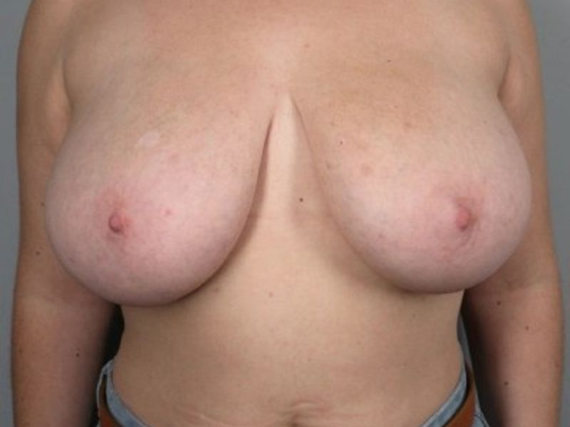 Before — Breast Reduction