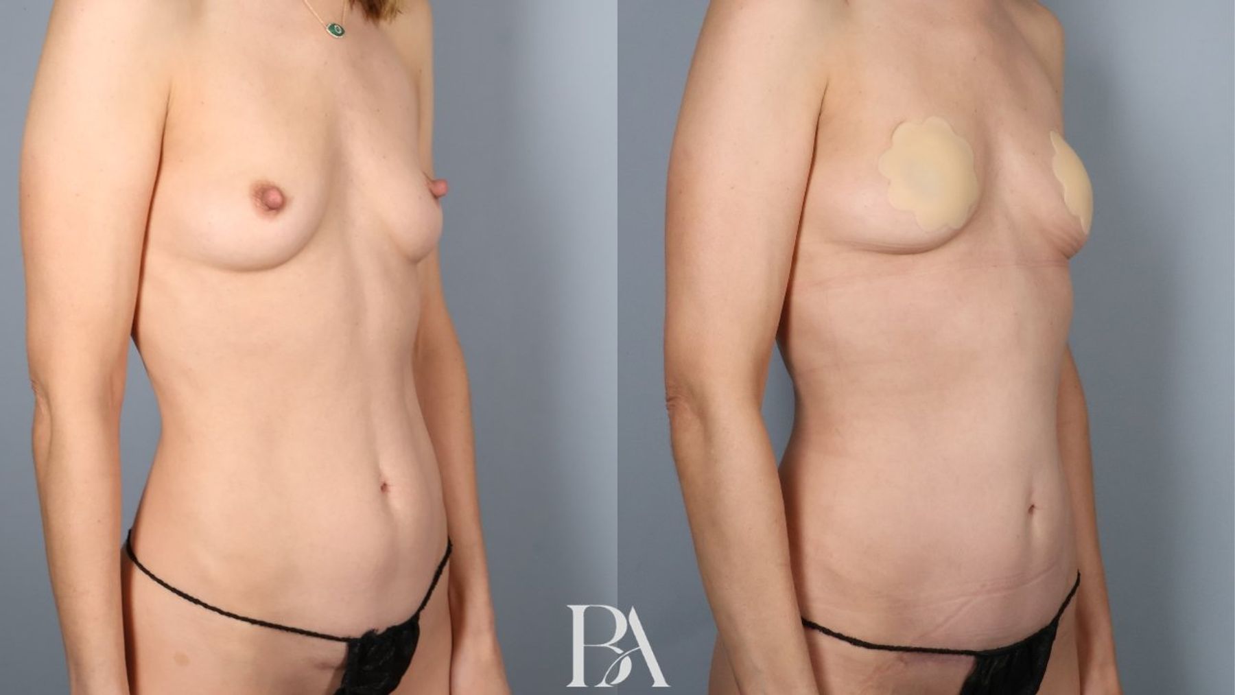 Tummy tuck before and after — side view, Dr. Beina Azadgoli, Beverly Hills