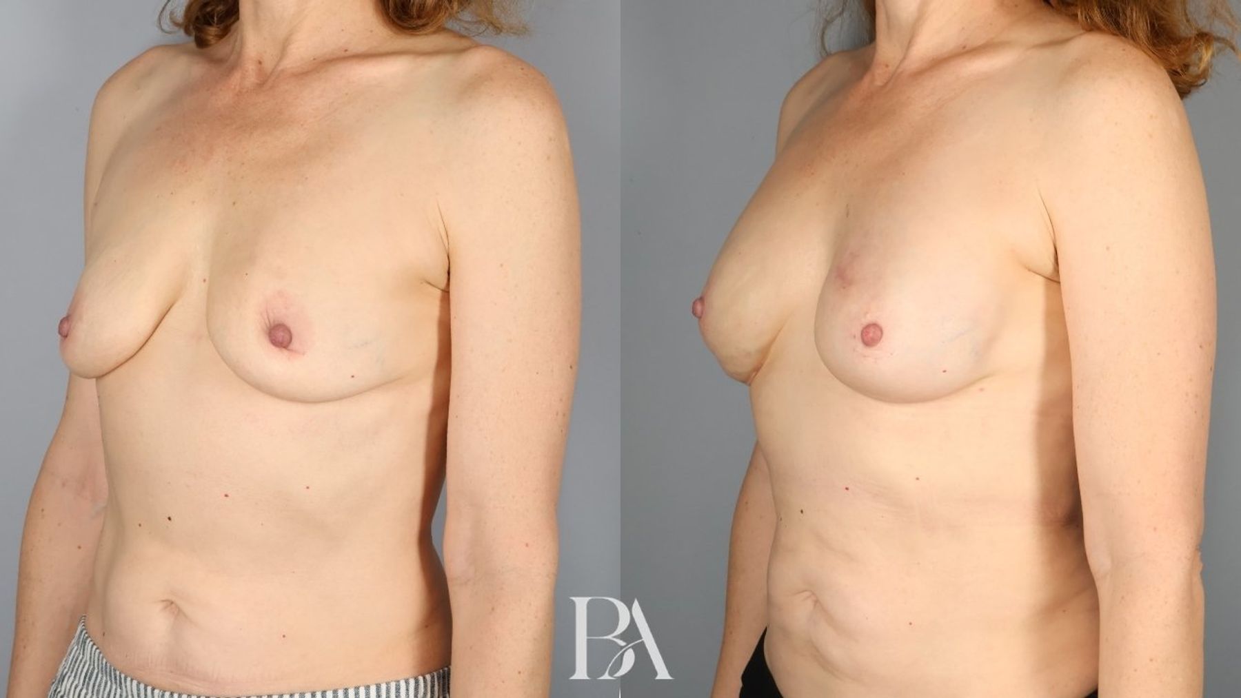 Direct-to-Implant Reconstruction before and after — three-quarter view, Dr. Beina Azadgoli, Beverly Hills