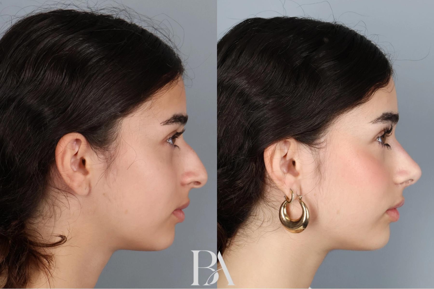 Rhinoplasty before and after — side view, Dr. Beina Azadgoli, Beverly Hills