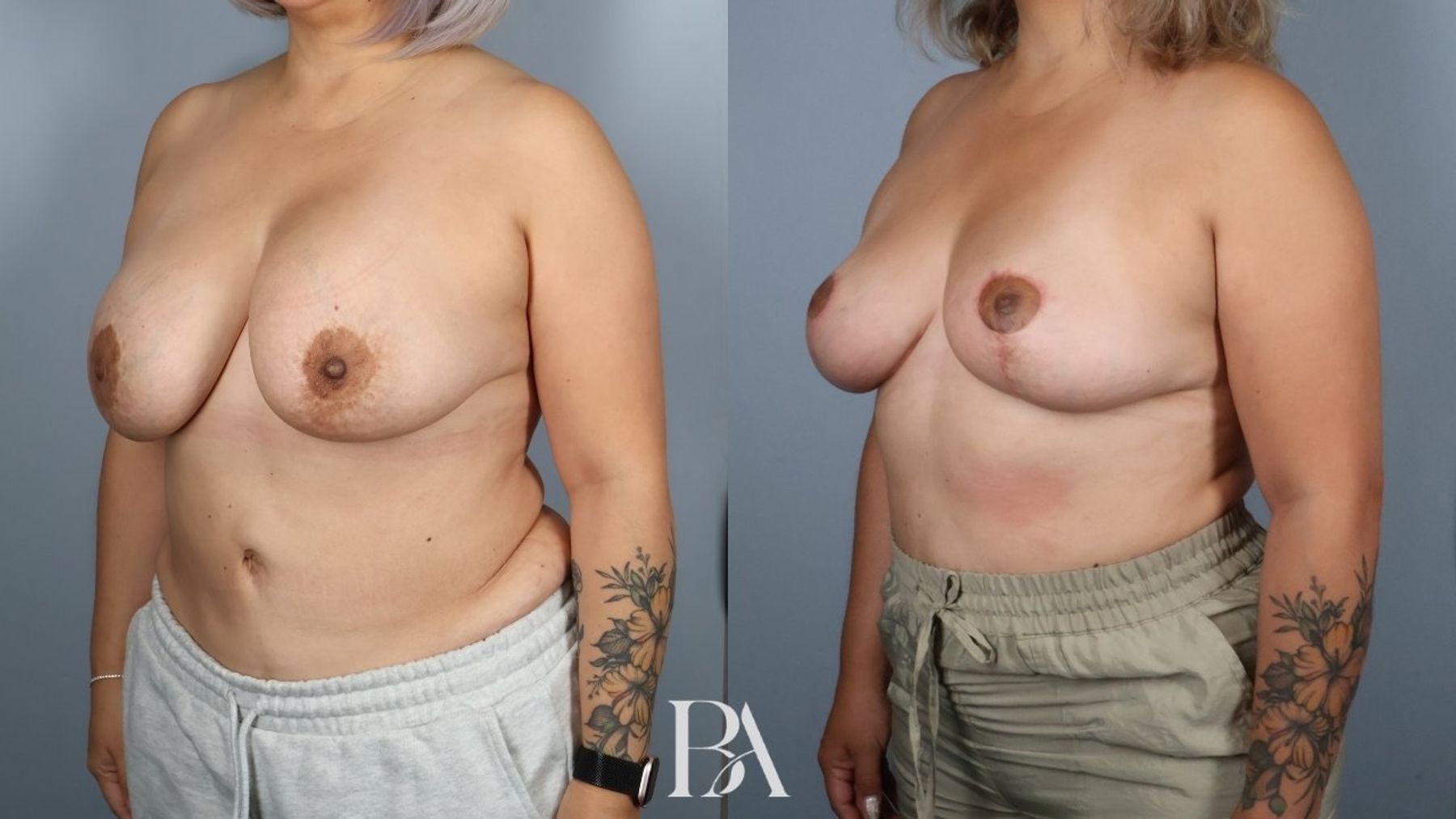Breast implant removal before and after — three-quarter view, Dr. Beina Azadgoli, Beverly Hills