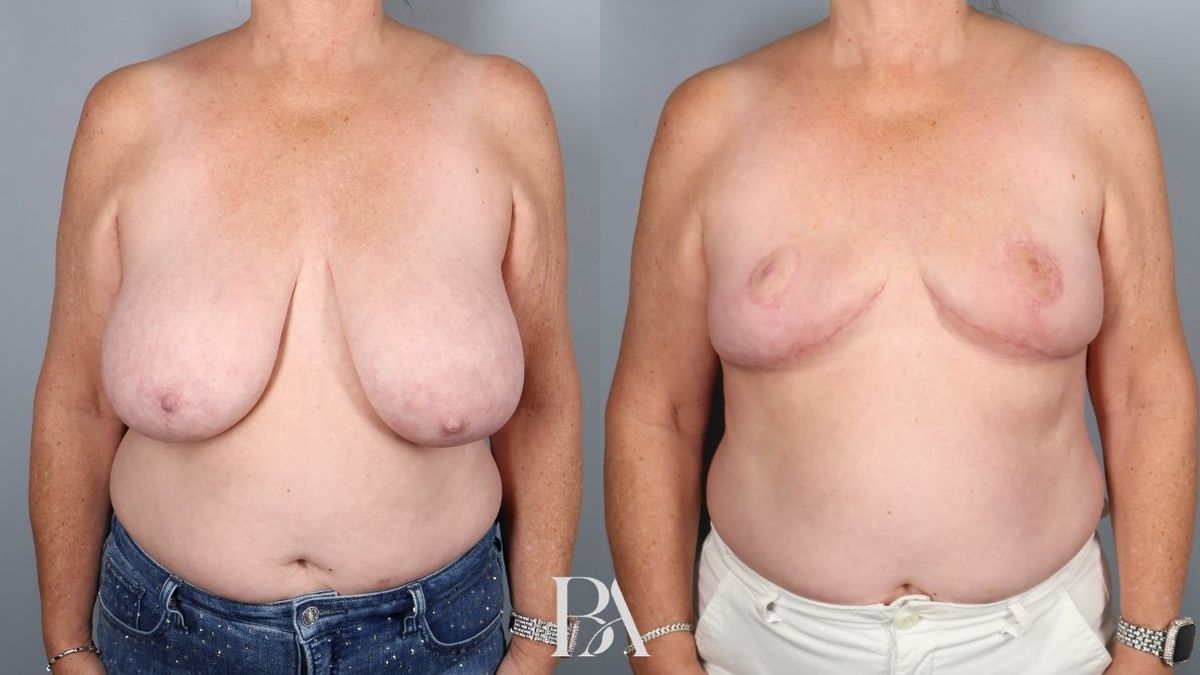 Before and after — SWIM Flap Reconstruction