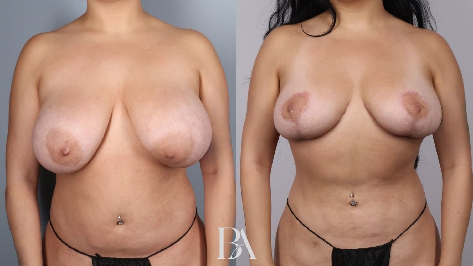 Breast reduction before and after — front view, Dr. Beina Azadgoli, Beverly Hills