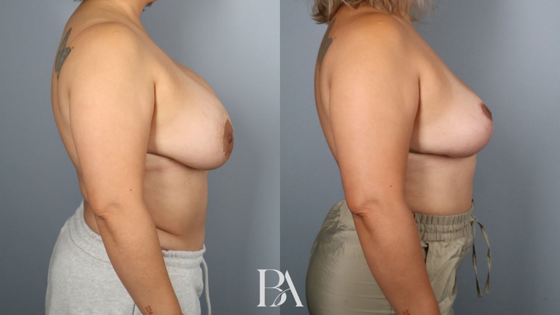 Breast implant removal before and after — side view, Dr. Beina Azadgoli, Beverly Hills