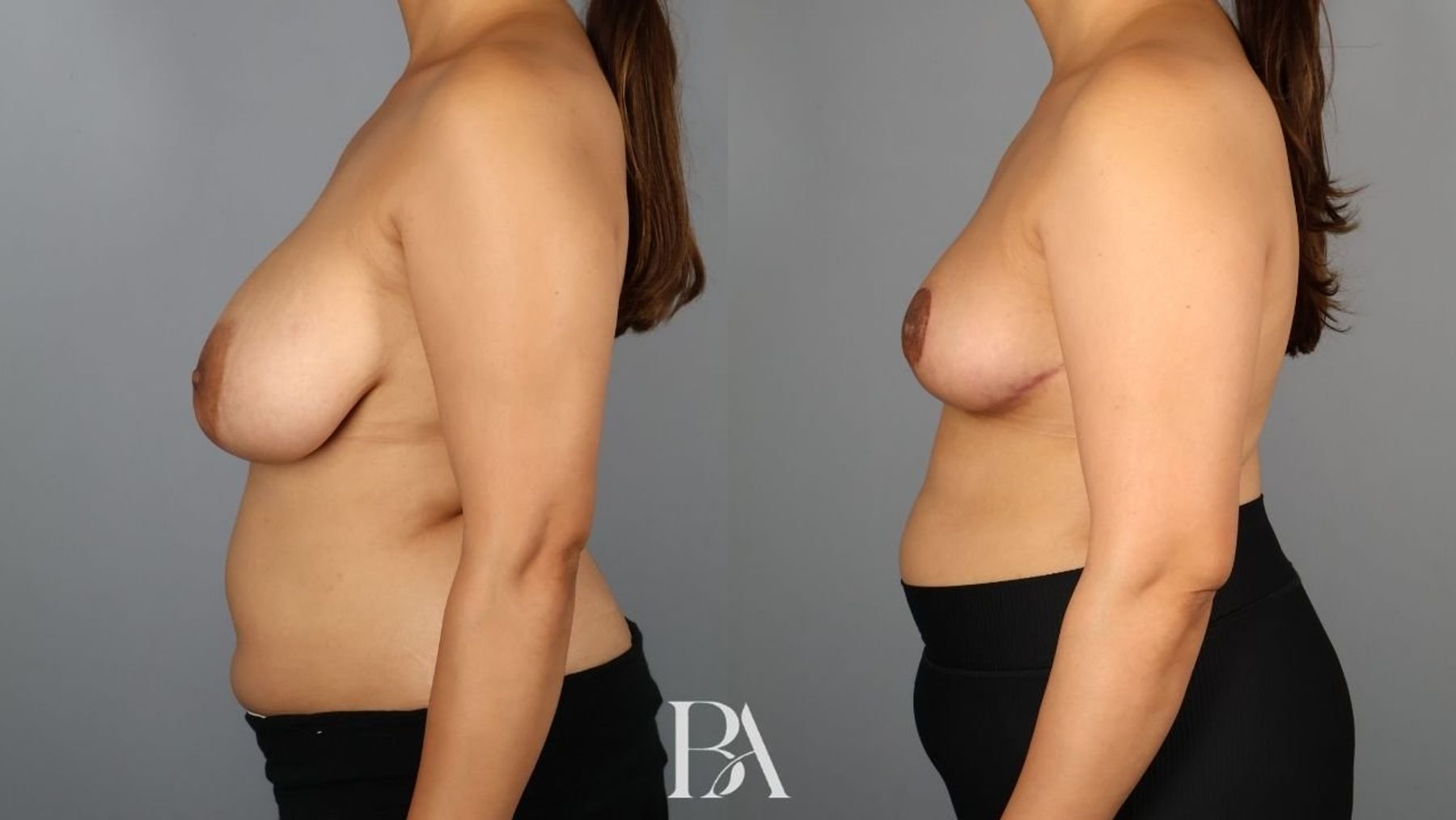 Breast reduction before and after — side view, Dr. Beina Azadgoli, Beverly Hills