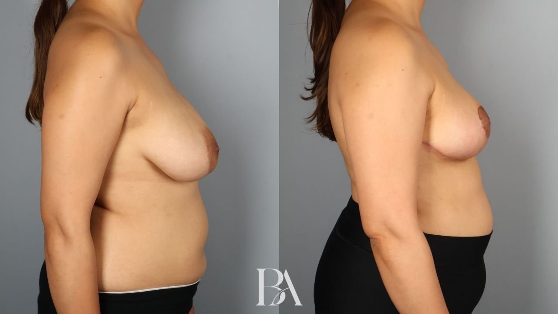Breast reduction before and after — side view, Dr. Beina Azadgoli, Beverly Hills