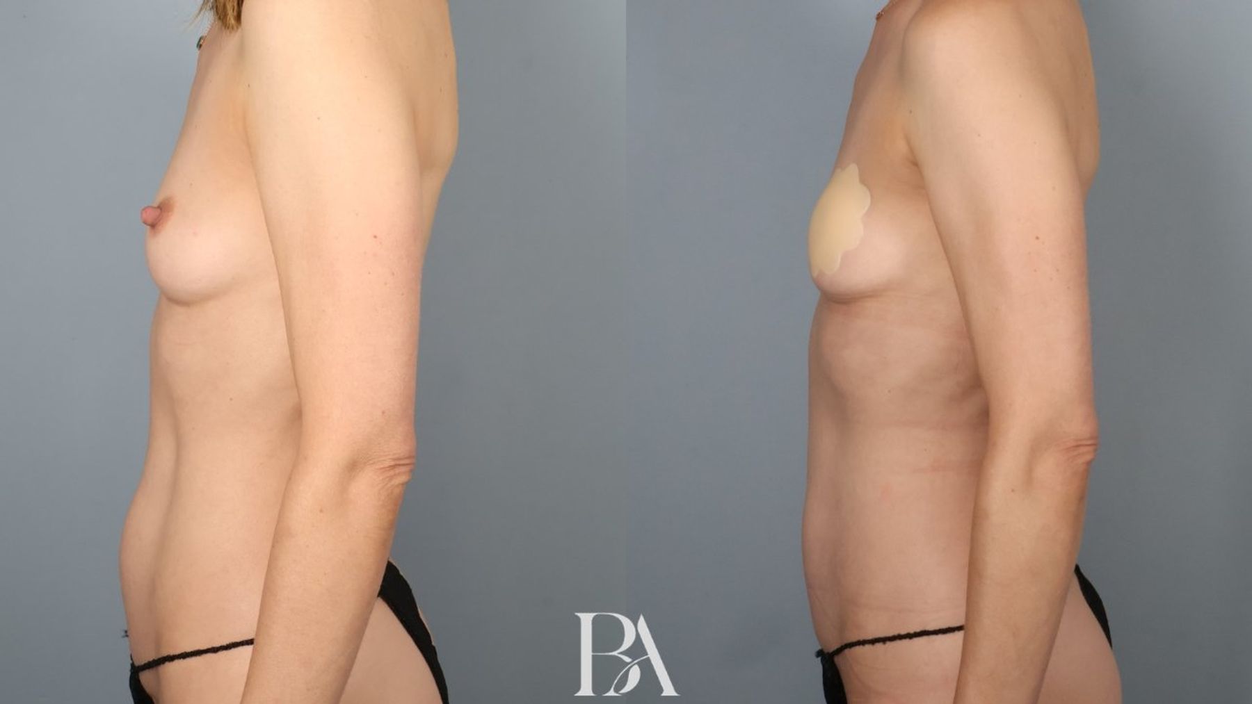 Tummy tuck before and after — three-quarter view, Dr. Beina Azadgoli, Beverly Hills