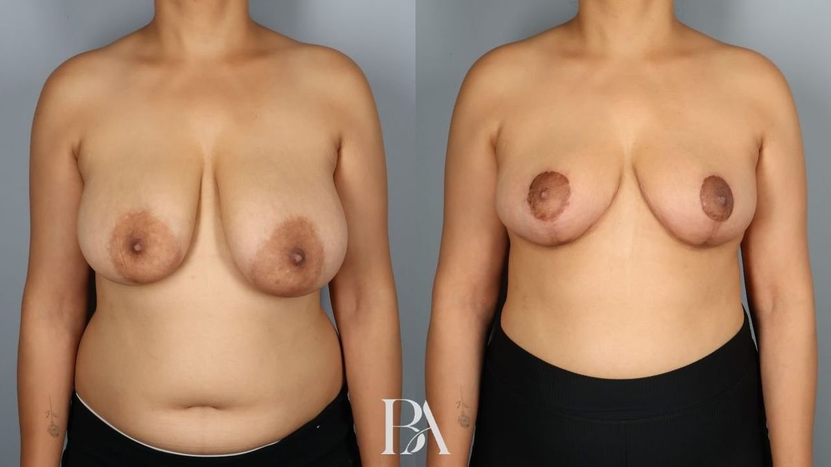 Before and after — Breast Reduction