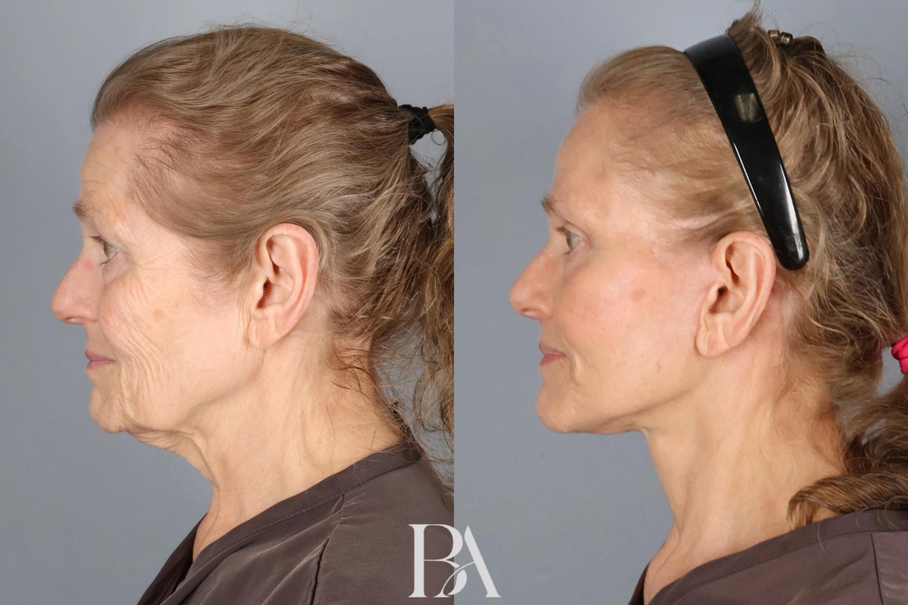 Face/Neck Lift before and after — side view, Dr. Beina Azadgoli, Beverly Hills