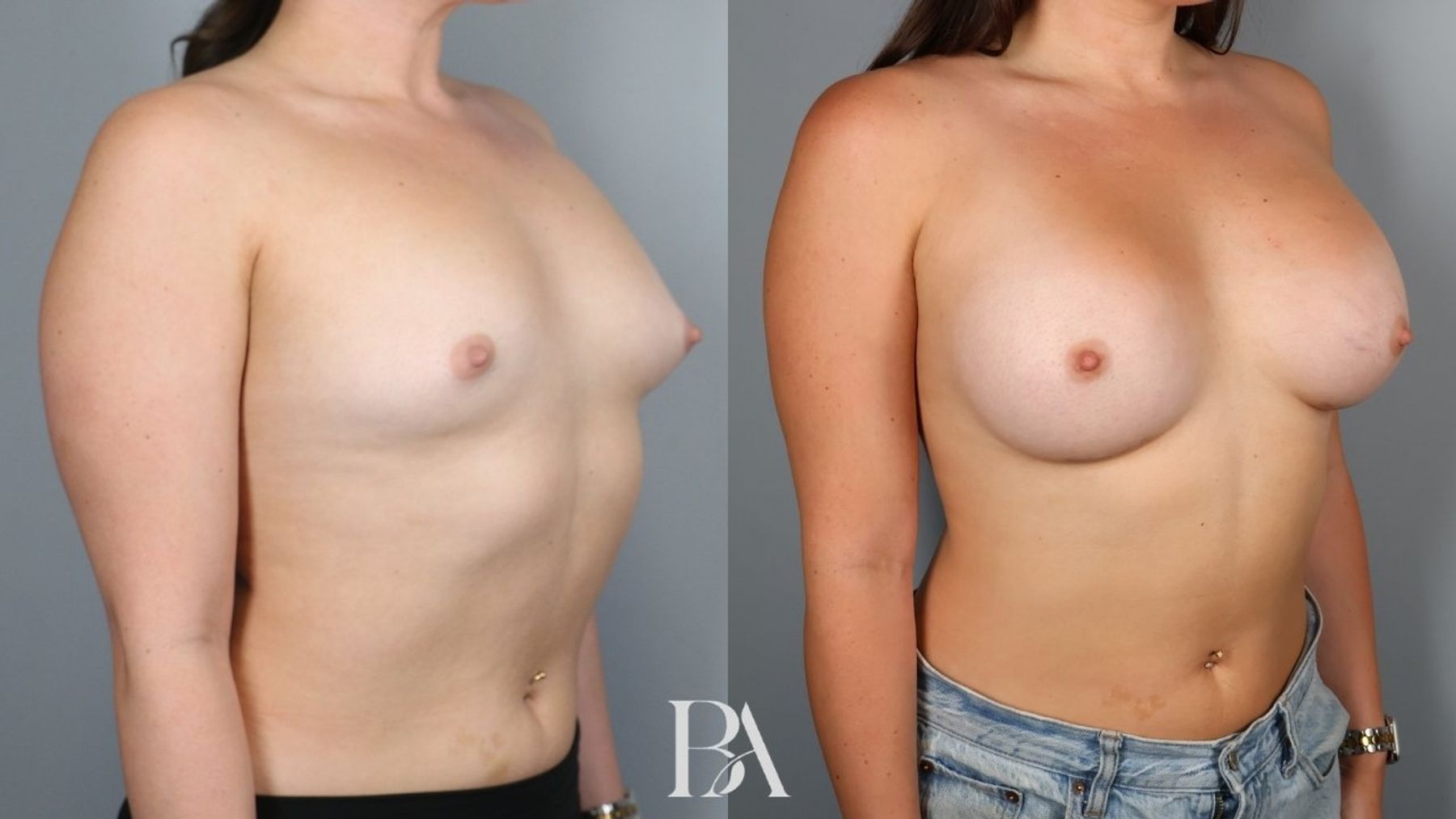 Breast augmentation before and after — oblique view, Dr. Beina Azadgoli, Beverly Hills