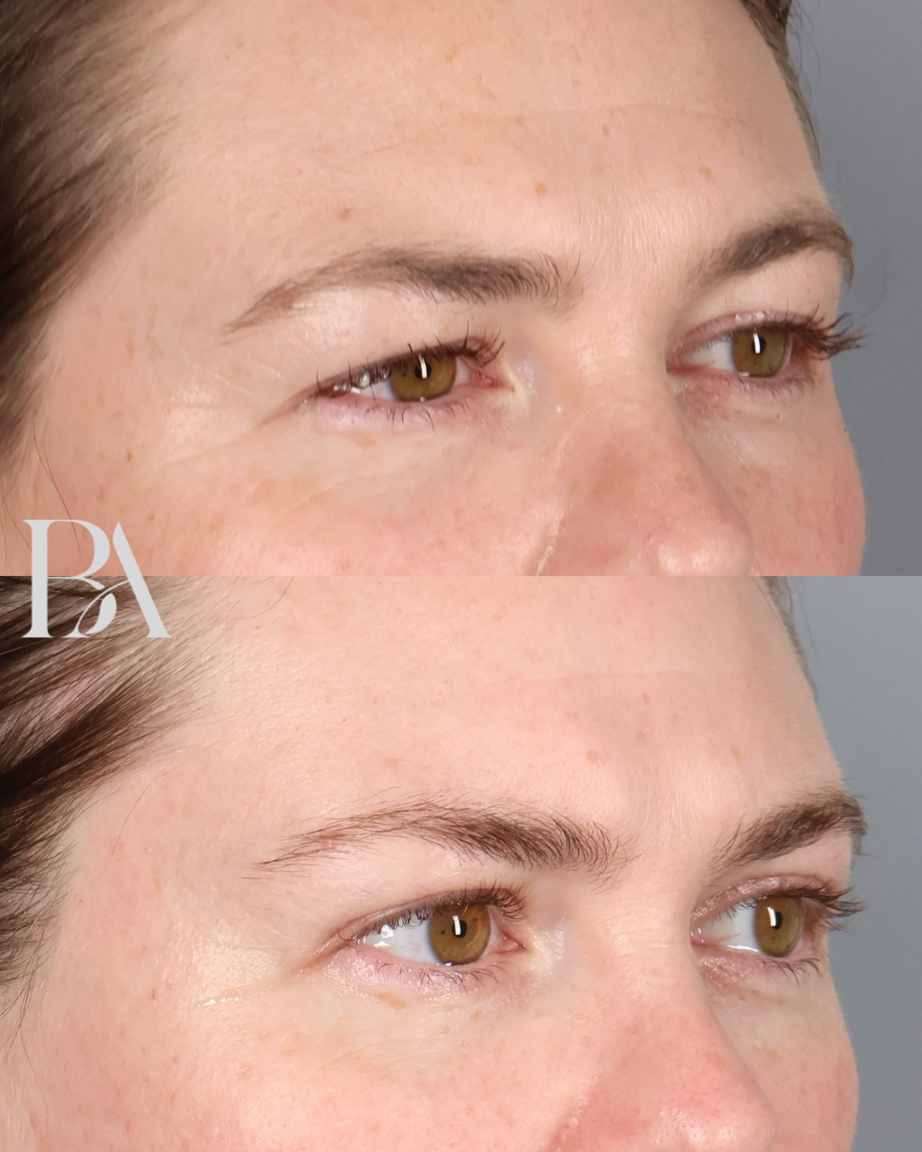 Upper Blepharoplasty before and after — oblique view, Dr. Beina Azadgoli, Beverly Hills