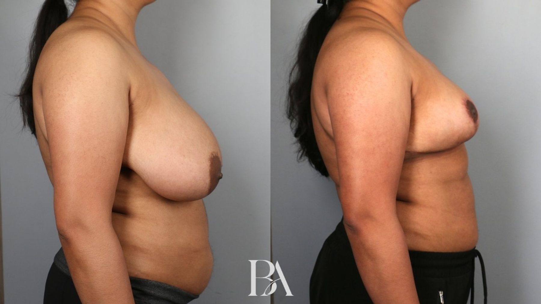 Breast reduction before and after — side view, Dr. Beina Azadgoli, Beverly Hills