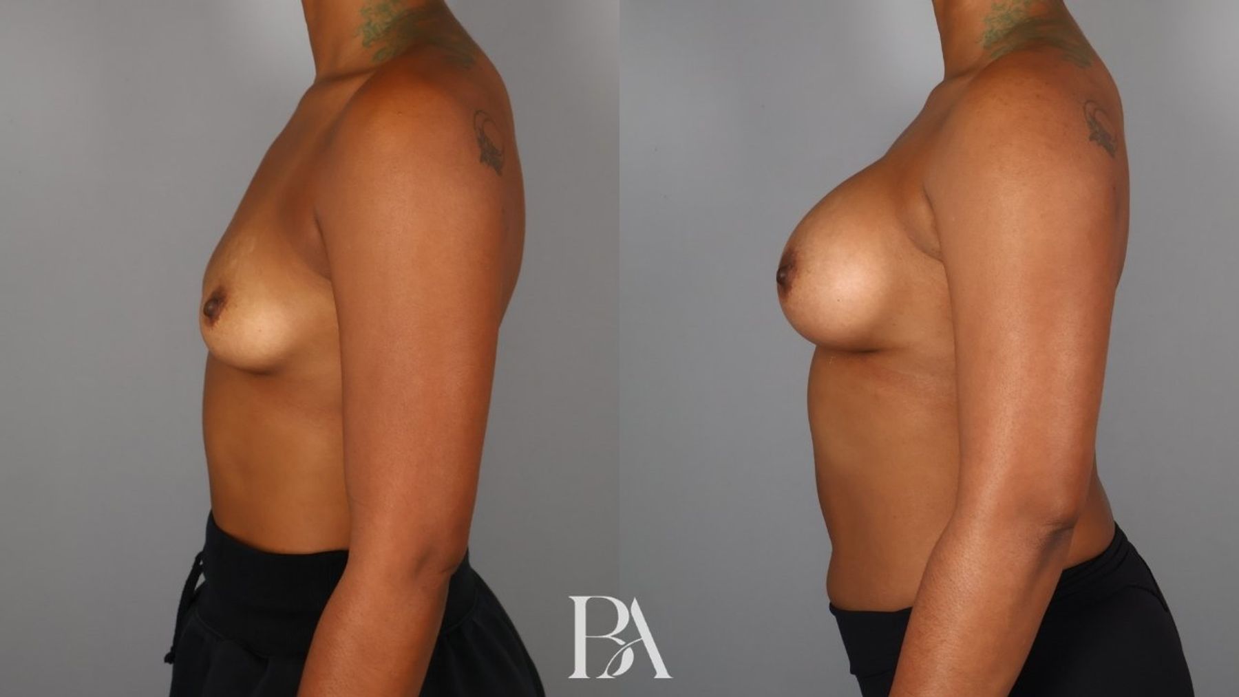 Breast augmentation before and after — side view, Dr. Beina Azadgoli, Beverly Hills
