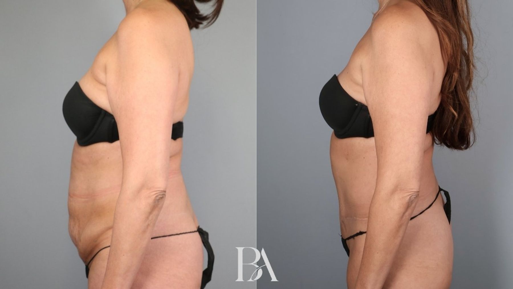 Tummy tuck before and after — side view, Dr. Beina Azadgoli, Beverly Hills