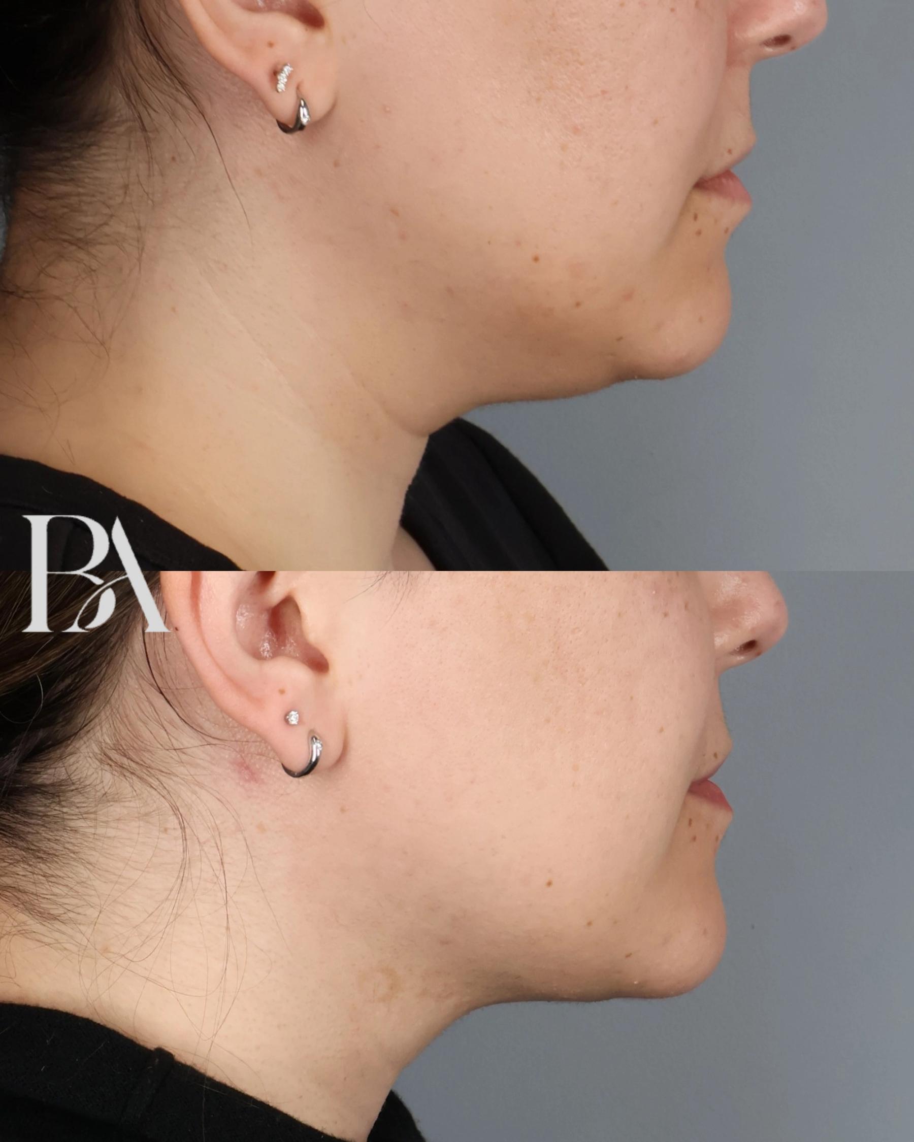 Submental Liposuction before and after — side view, Dr. Beina Azadgoli, Beverly Hills