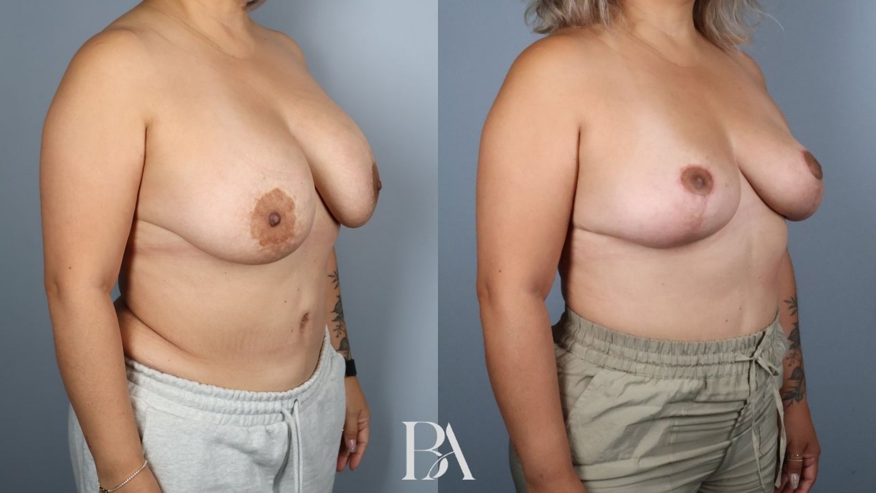 Breast implant removal before and after — oblique view, Dr. Beina Azadgoli, Beverly Hills