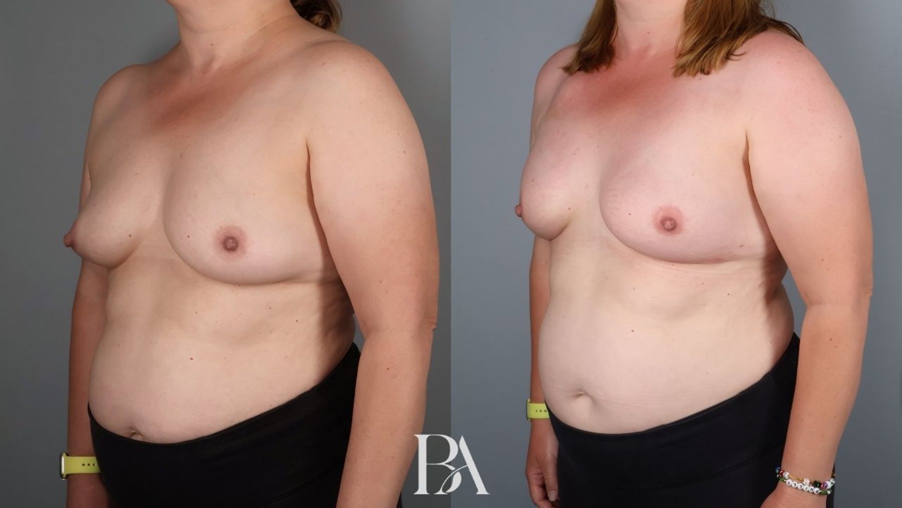 Direct-to-Implant Reconstruction before and after — three-quarter view, Dr. Beina Azadgoli, Beverly Hills