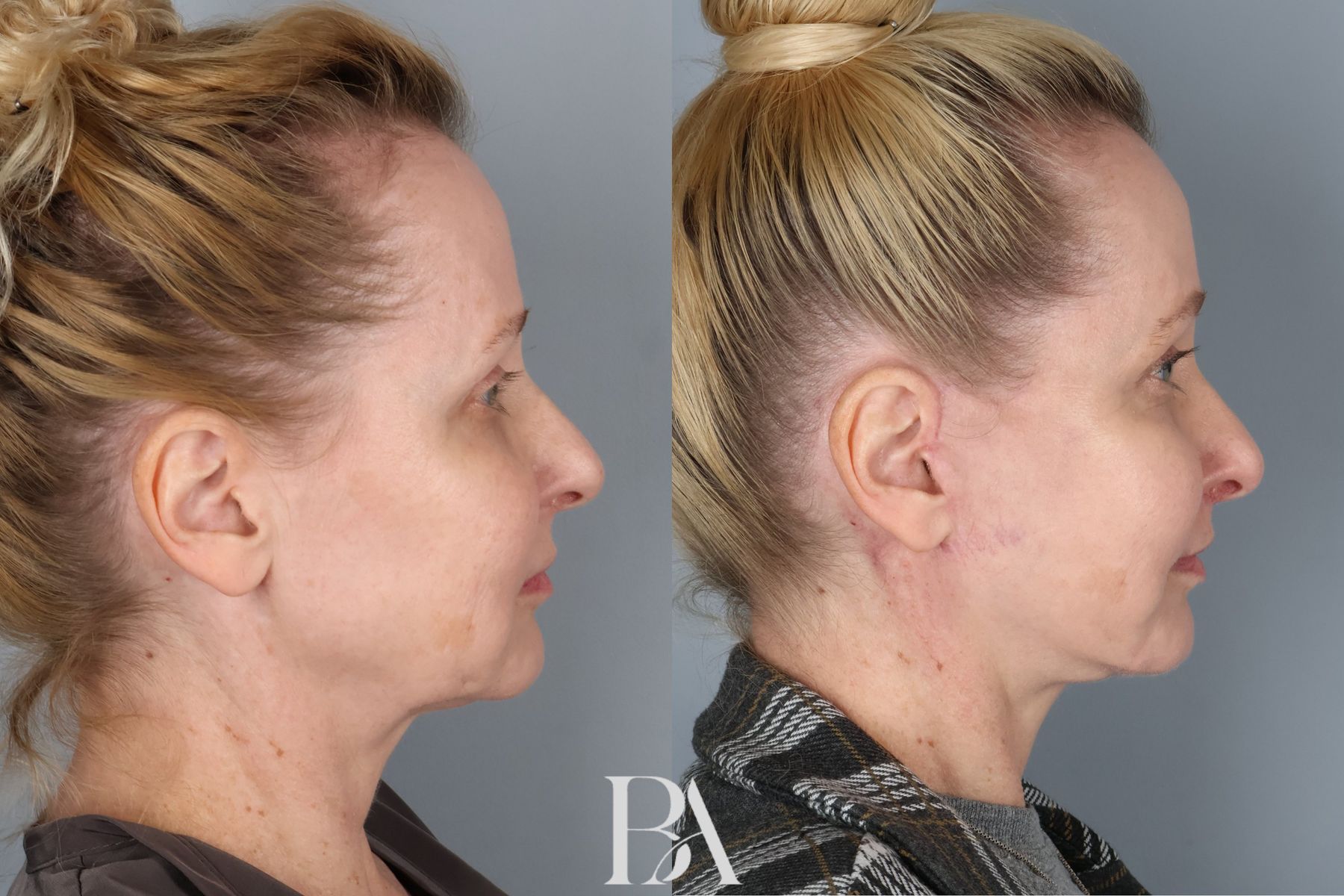 Face/Neck Lift before and after — side view, Dr. Beina Azadgoli, Beverly Hills