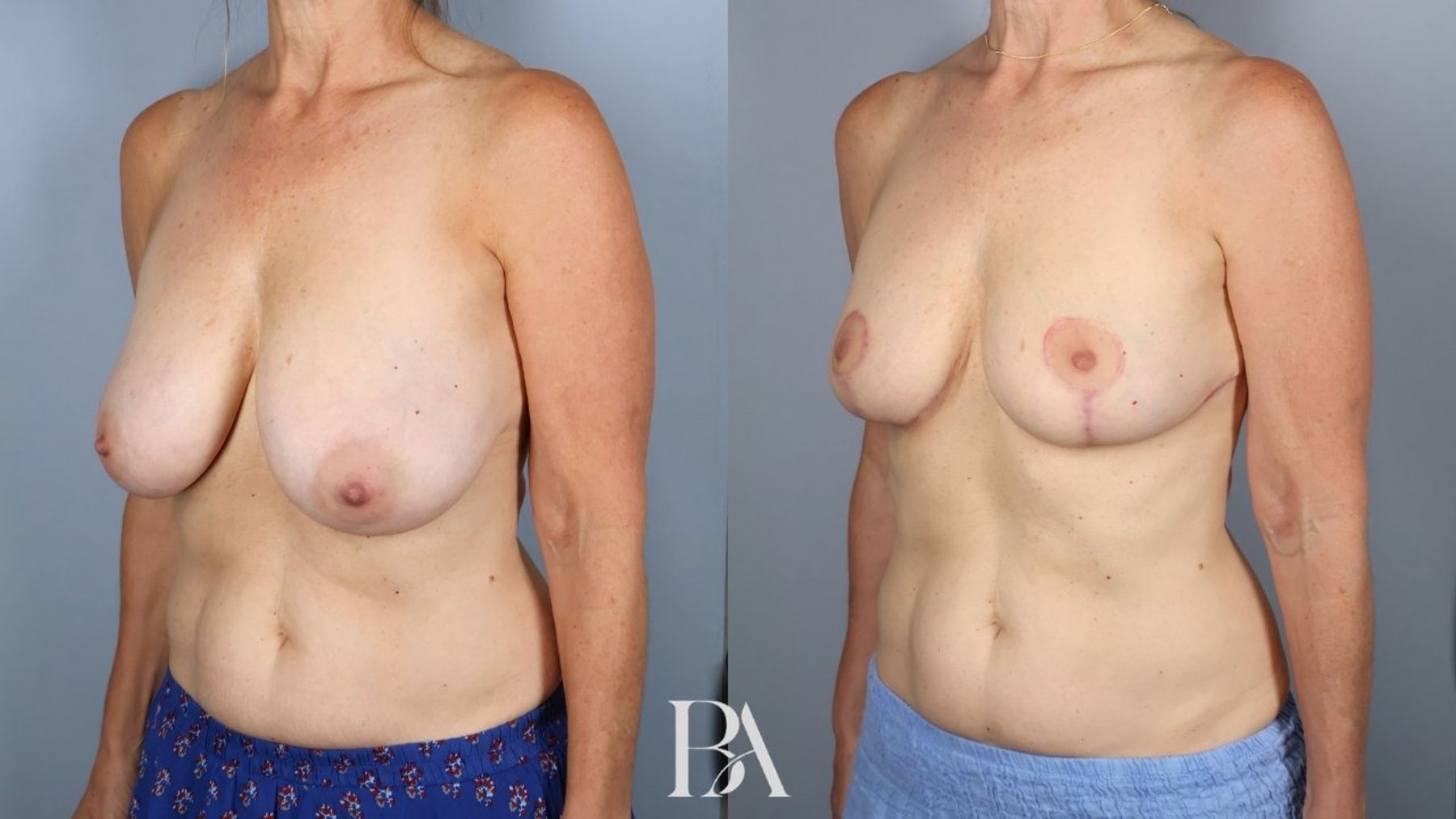 Breast reduction before and after — three-quarter view, Dr. Beina Azadgoli, Beverly Hills