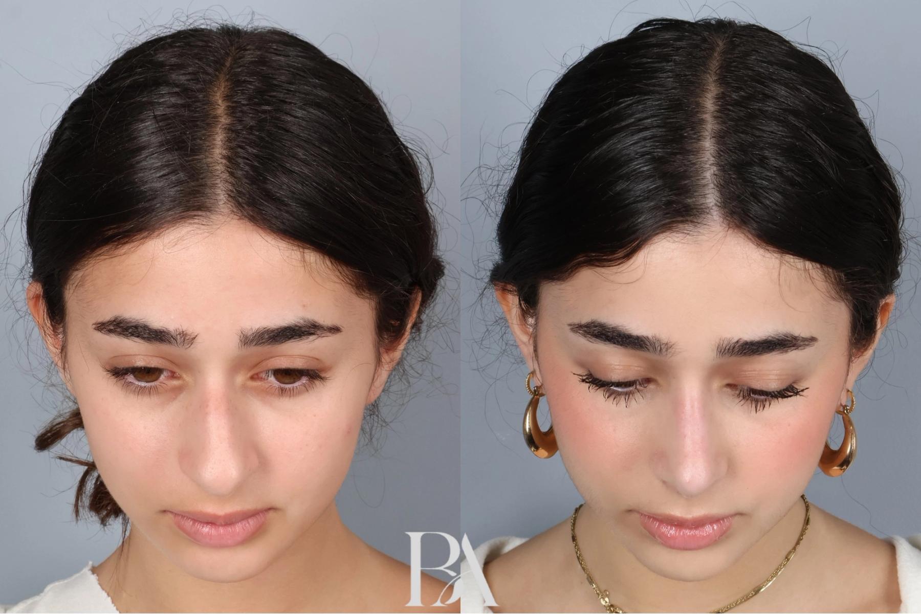 Rhinoplasty before and after — detail view, Dr. Beina Azadgoli, Beverly Hills