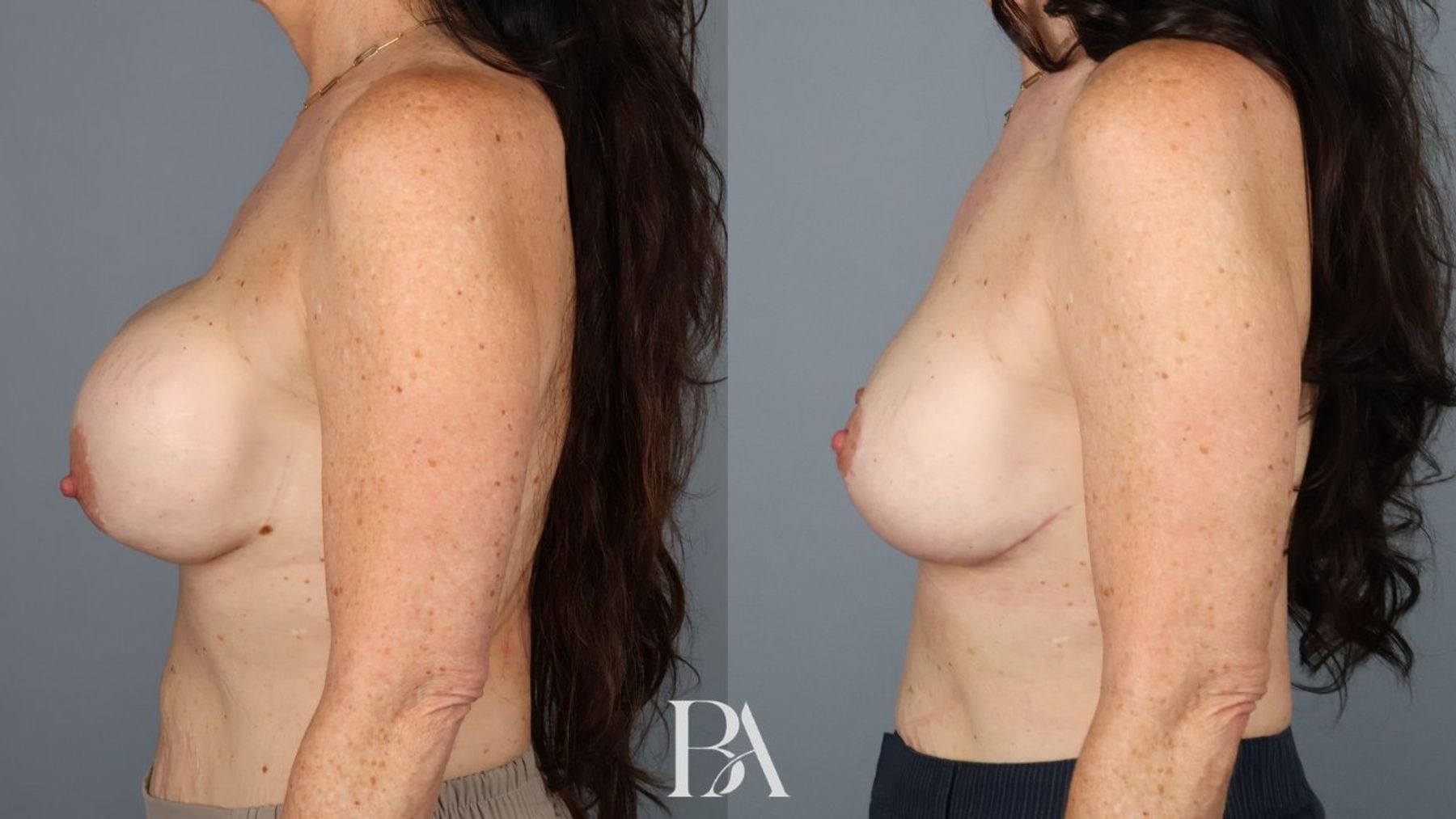 Implant Removal and Replacement before and after — side view, Dr. Beina Azadgoli, Beverly Hills