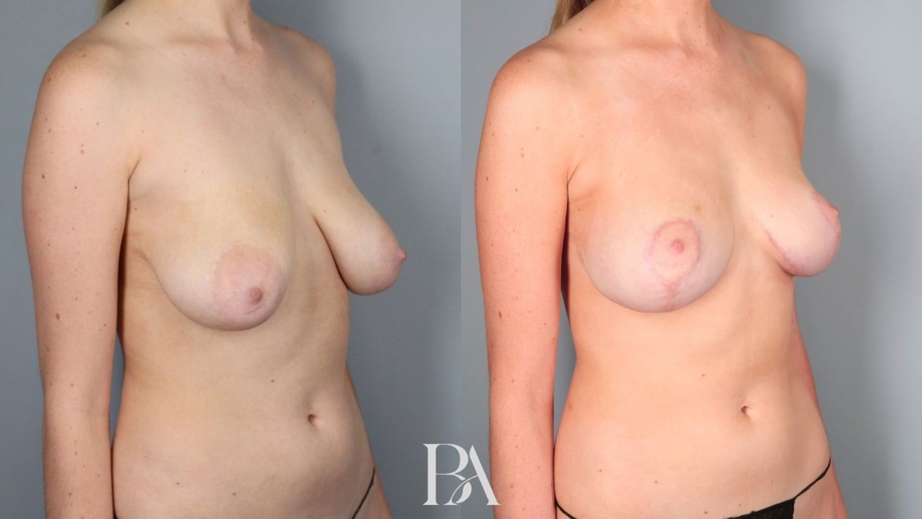 Breast lift before and after — oblique view, Dr. Beina Azadgoli, Beverly Hills