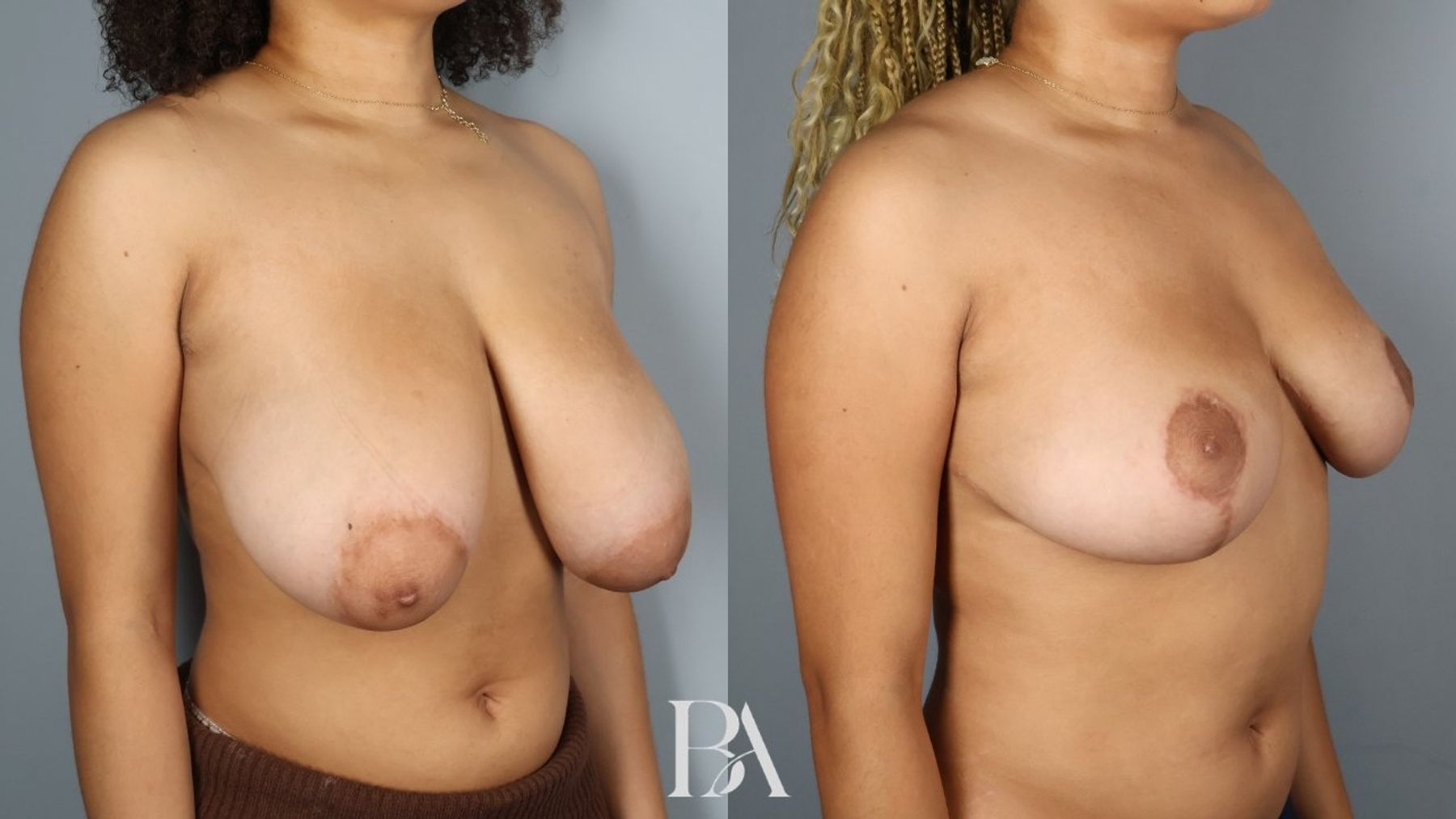 Breast reduction before and after — oblique view, Dr. Beina Azadgoli, Beverly Hills