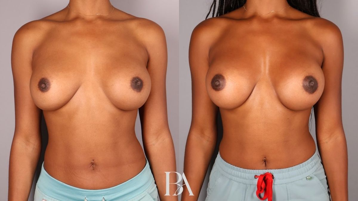 Implant Removal and Replacement before and after — front view, Dr. Beina Azadgoli, Beverly Hills