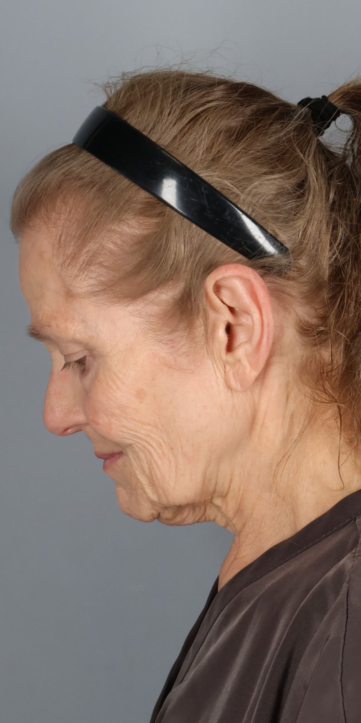 Face/neck lift before — detail view, Dr. Beina Azadgoli, Beverly Hills