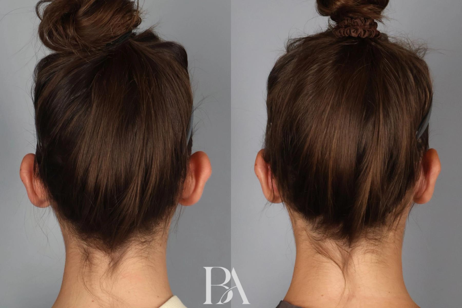 Ear Pinning before and after — back view, Dr. Beina Azadgoli, Beverly Hills