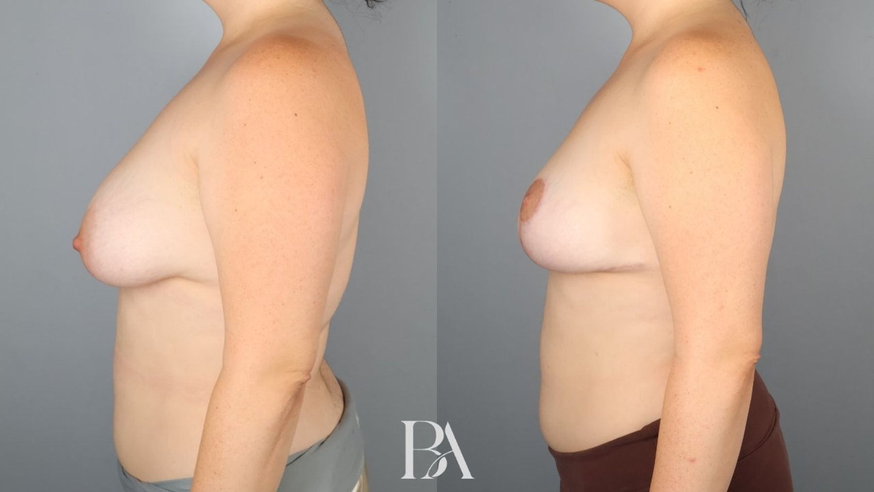 Breast lift before and after — side view, Dr. Beina Azadgoli, Beverly Hills