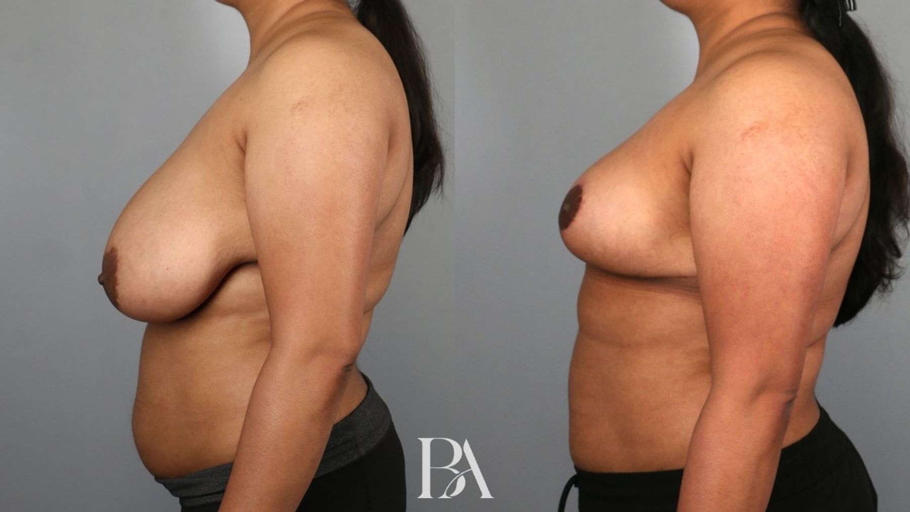 Breast reduction before and after — side view, Dr. Beina Azadgoli, Beverly Hills