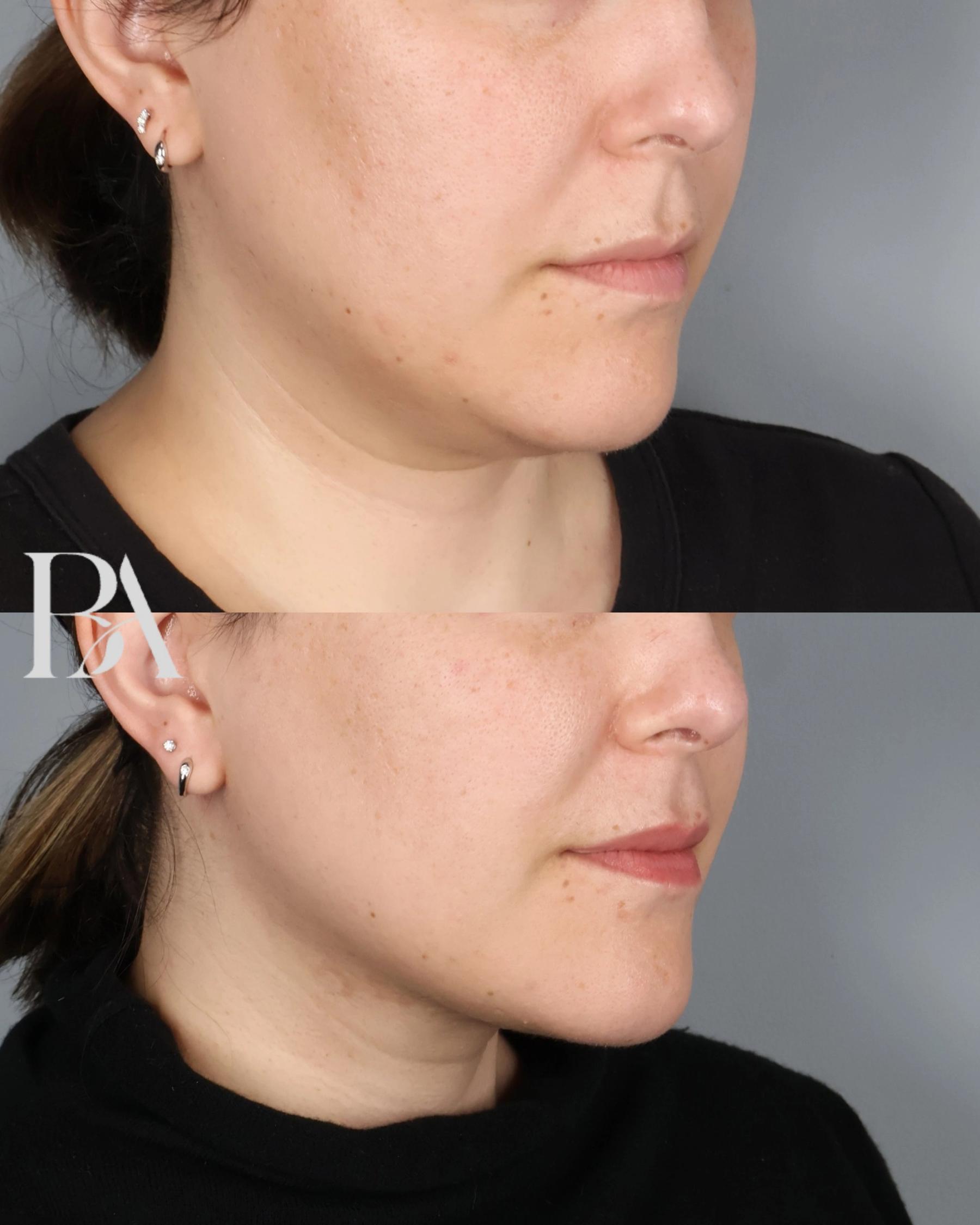 Submental Liposuction before and after — oblique view, Dr. Beina Azadgoli, Beverly Hills