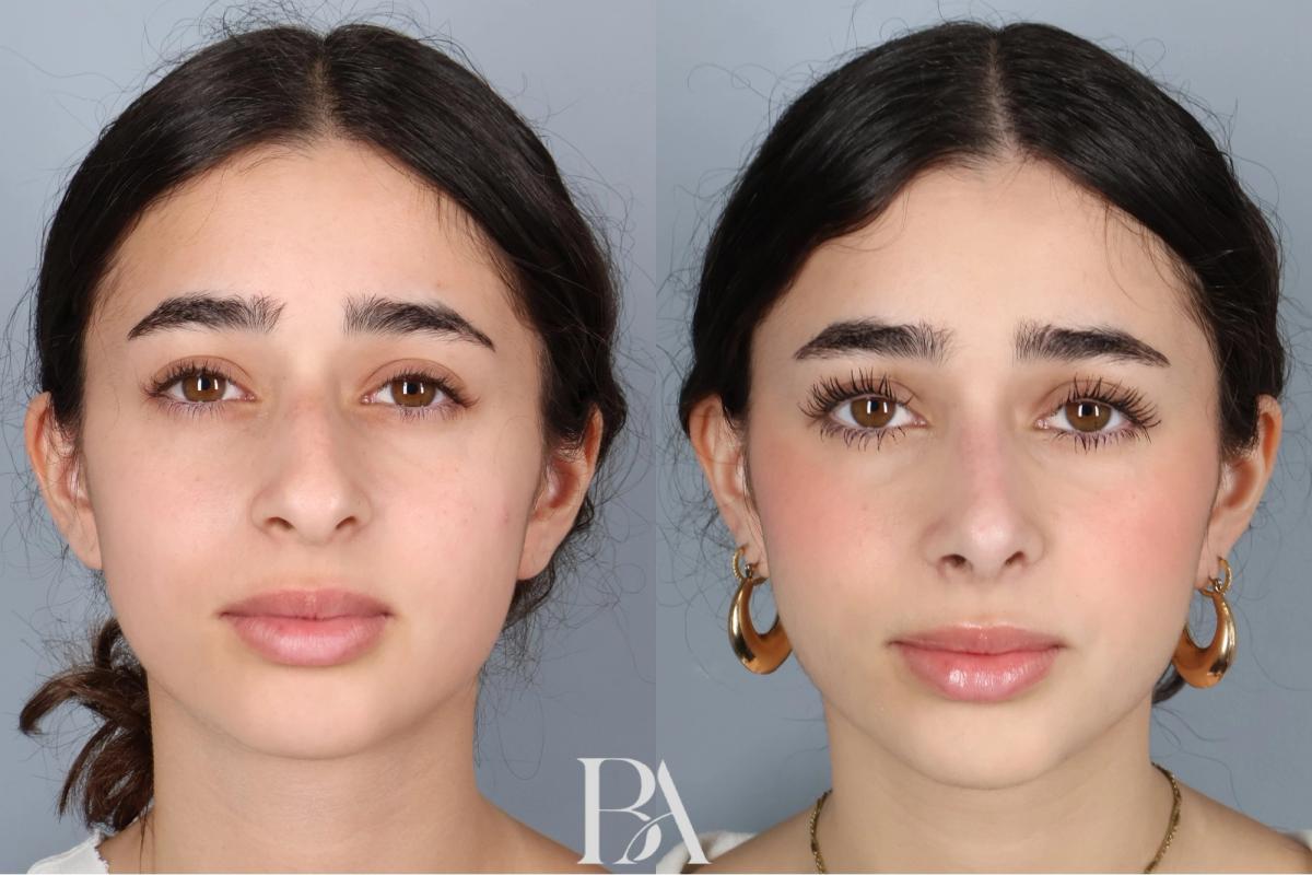 Before and after — Rhinoplasty