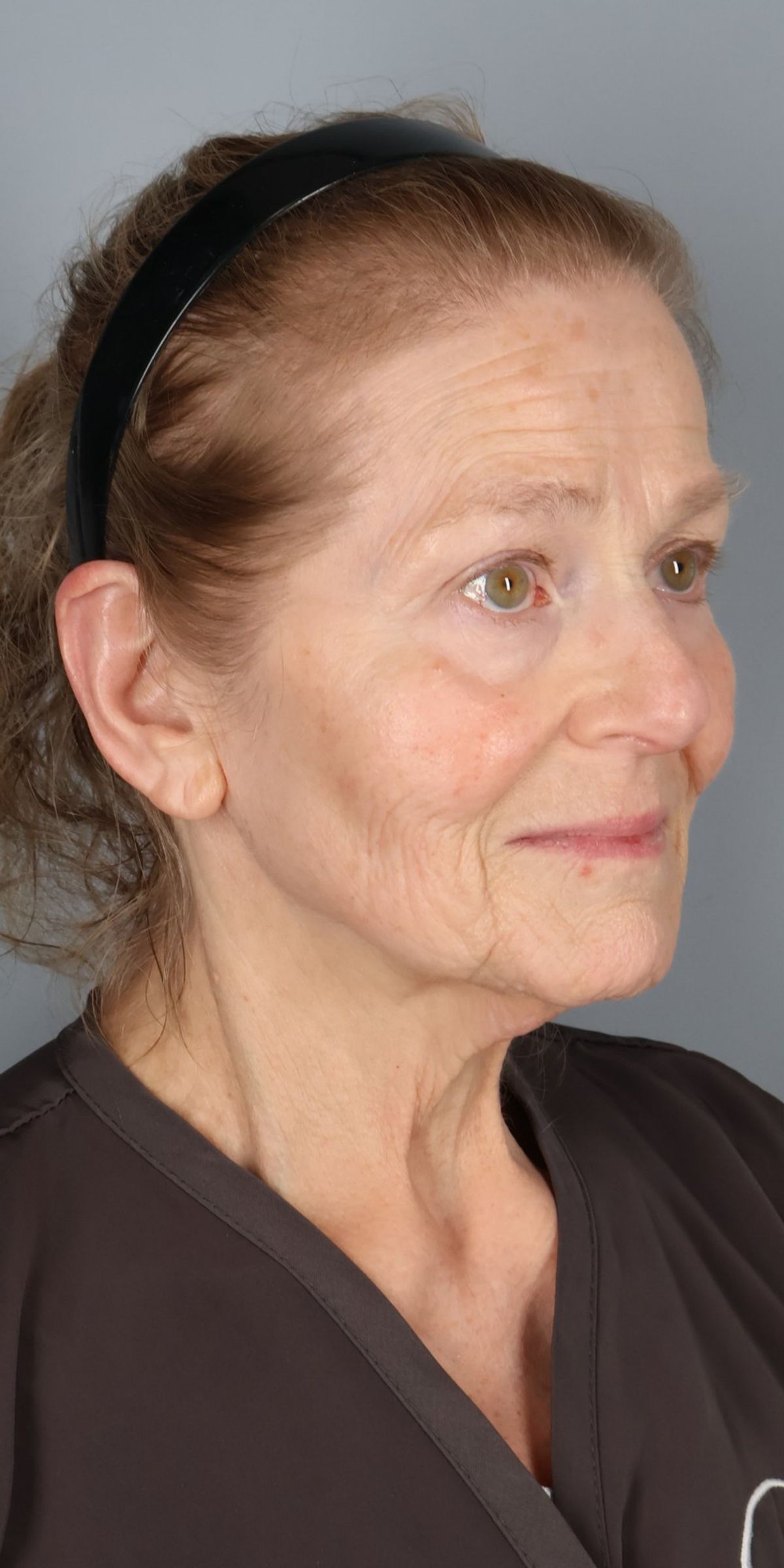 Face/neck lift before — oblique view, Dr. Beina Azadgoli, Beverly Hills