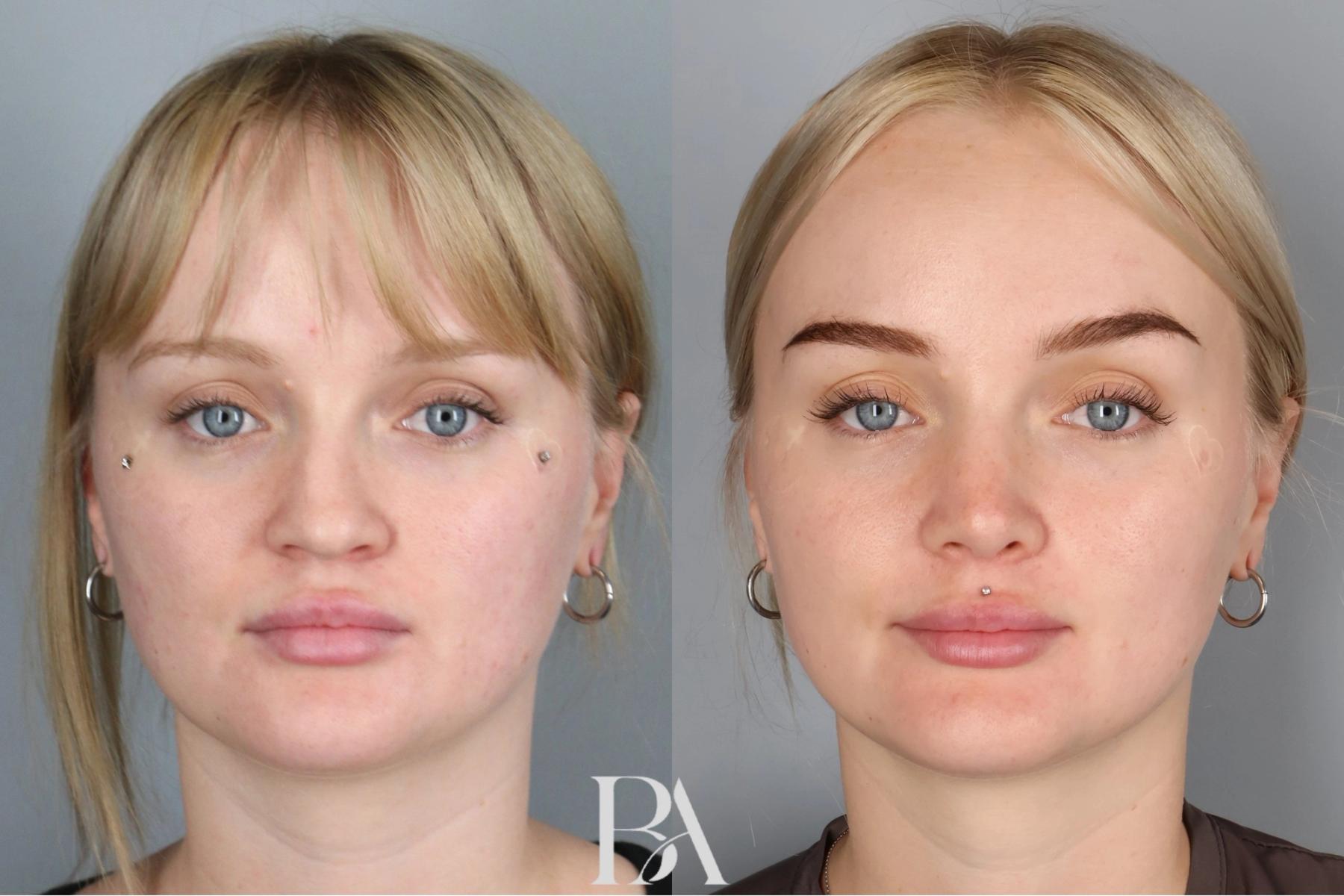 Rhinoplasty before and after — front view, Dr. Beina Azadgoli, Beverly Hills
