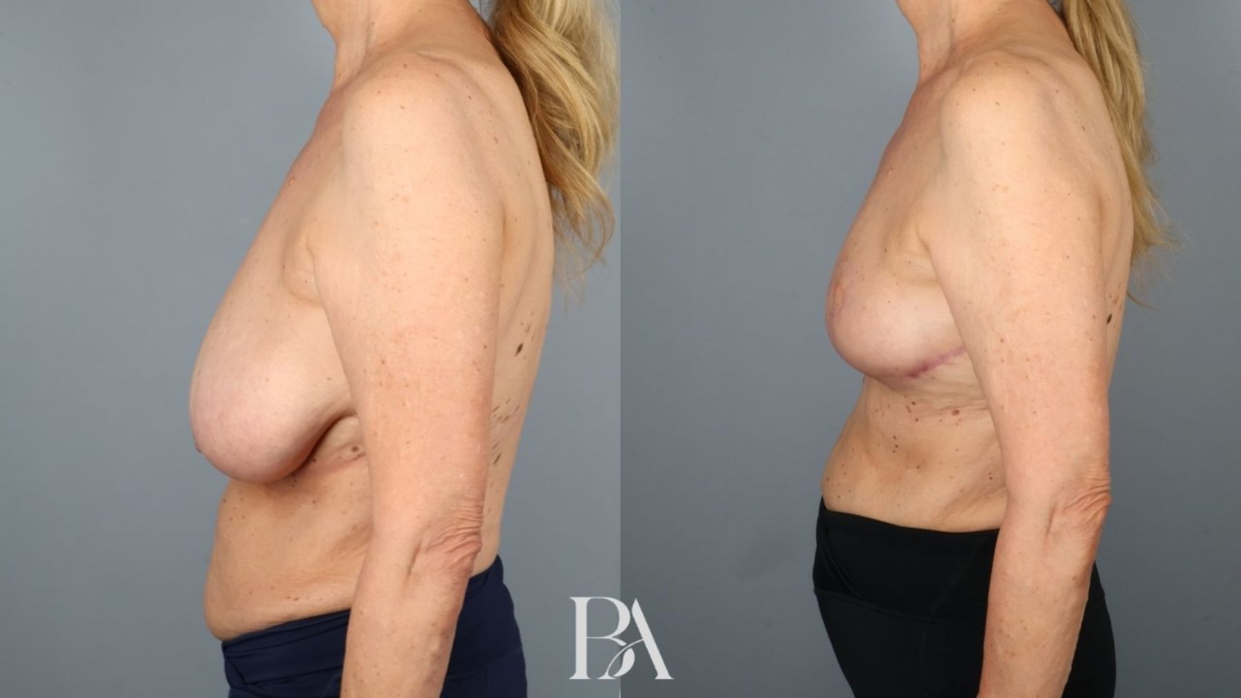 Breast reduction before and after — side view, Dr. Beina Azadgoli, Beverly Hills