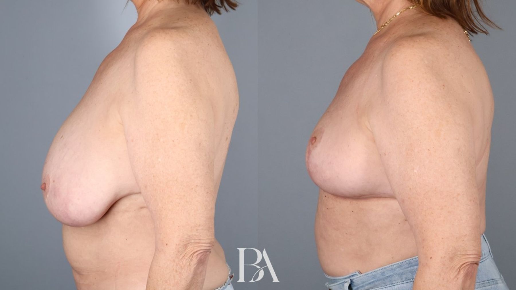Breast reduction before and after — side view, Dr. Beina Azadgoli, Beverly Hills